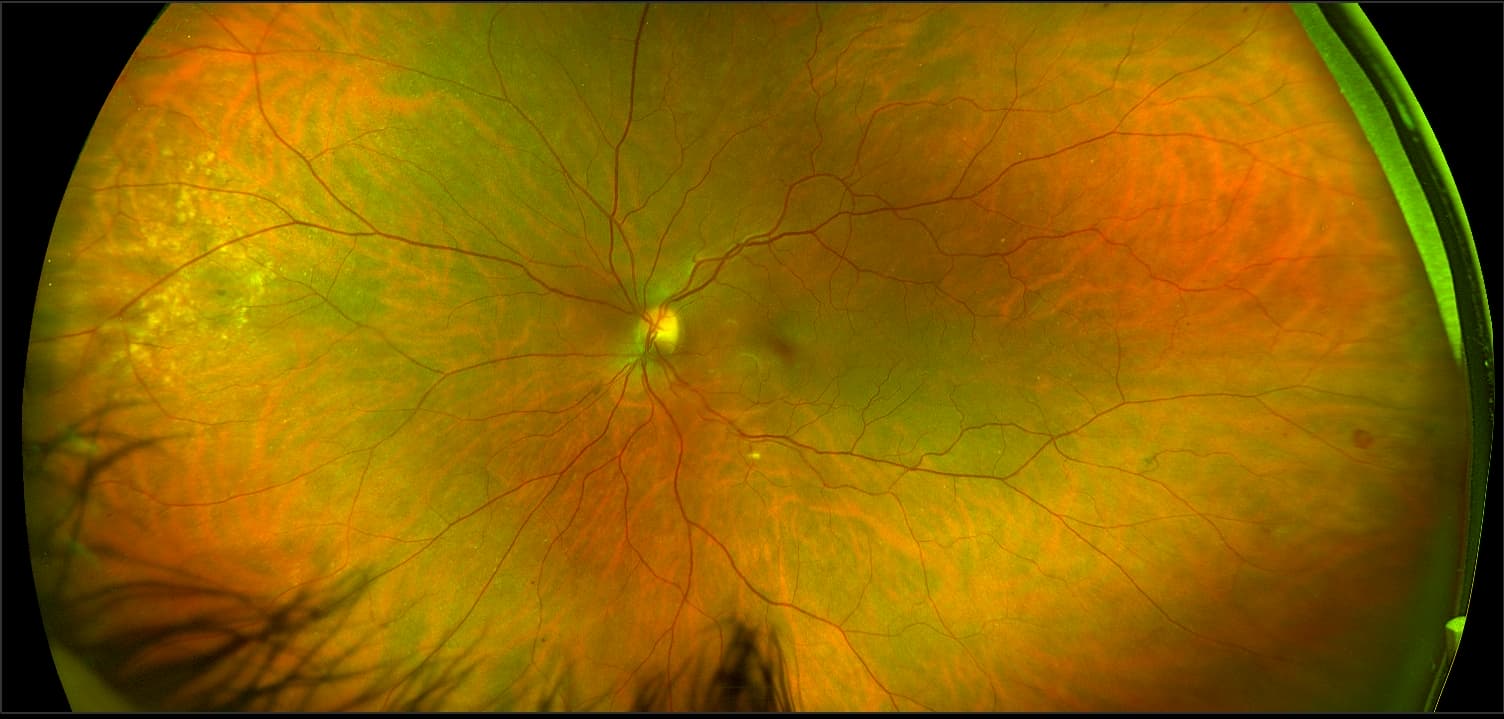 California - Hyperviscosity Retinopathy from Myeloma, RG