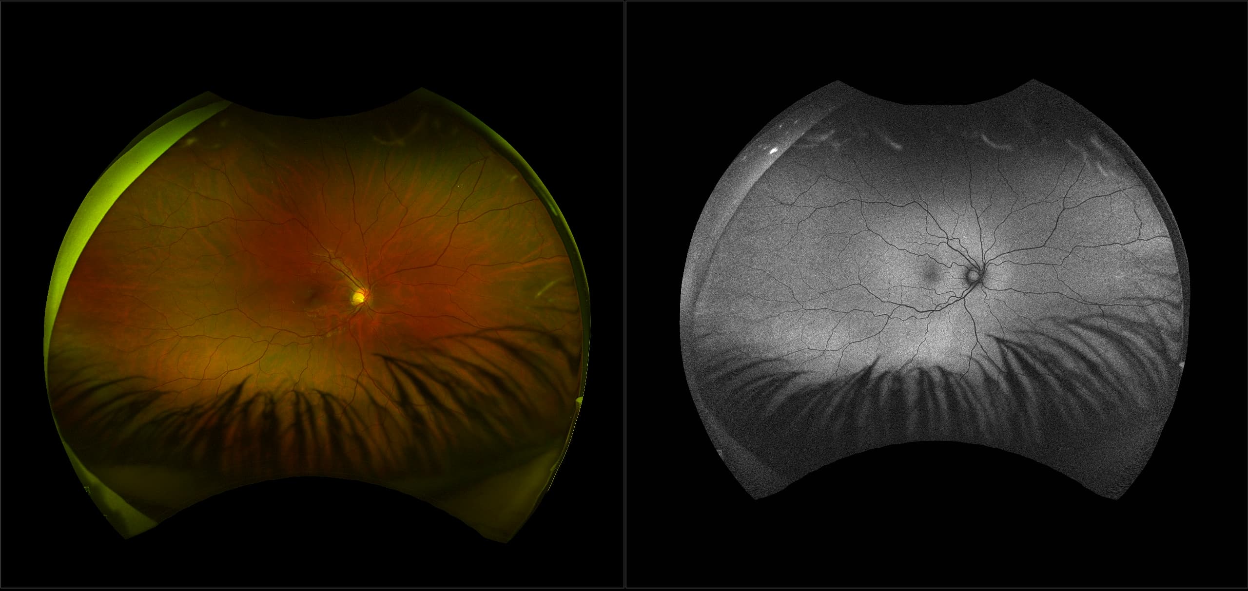 California - Valsalva Retinopathy, RG, AF