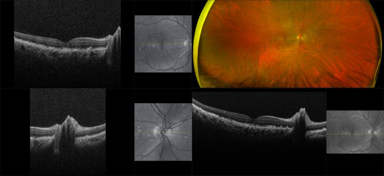 Monaco - Dry AMD, RG, OCT