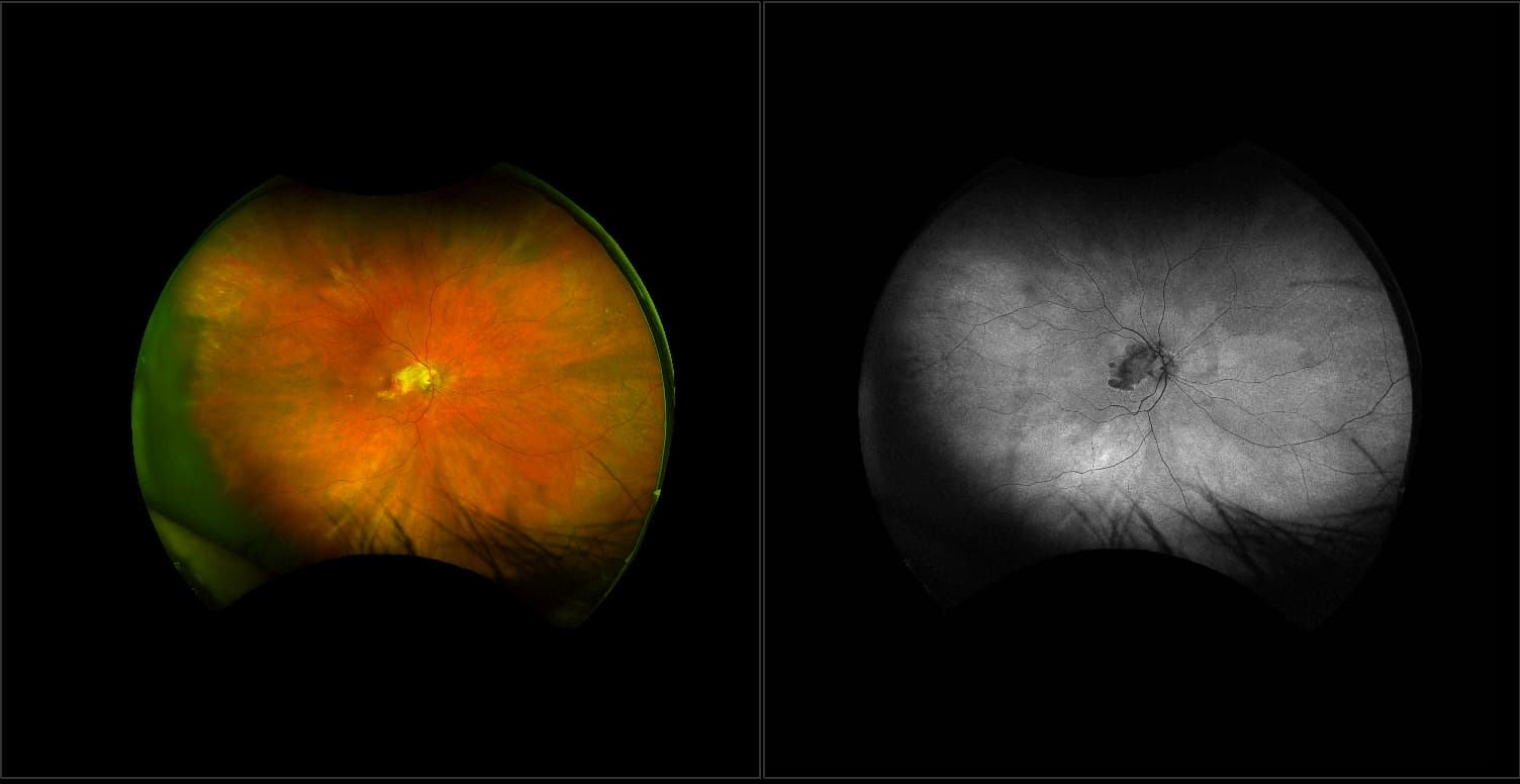 California - Choroidal Osteoma, RG, AF