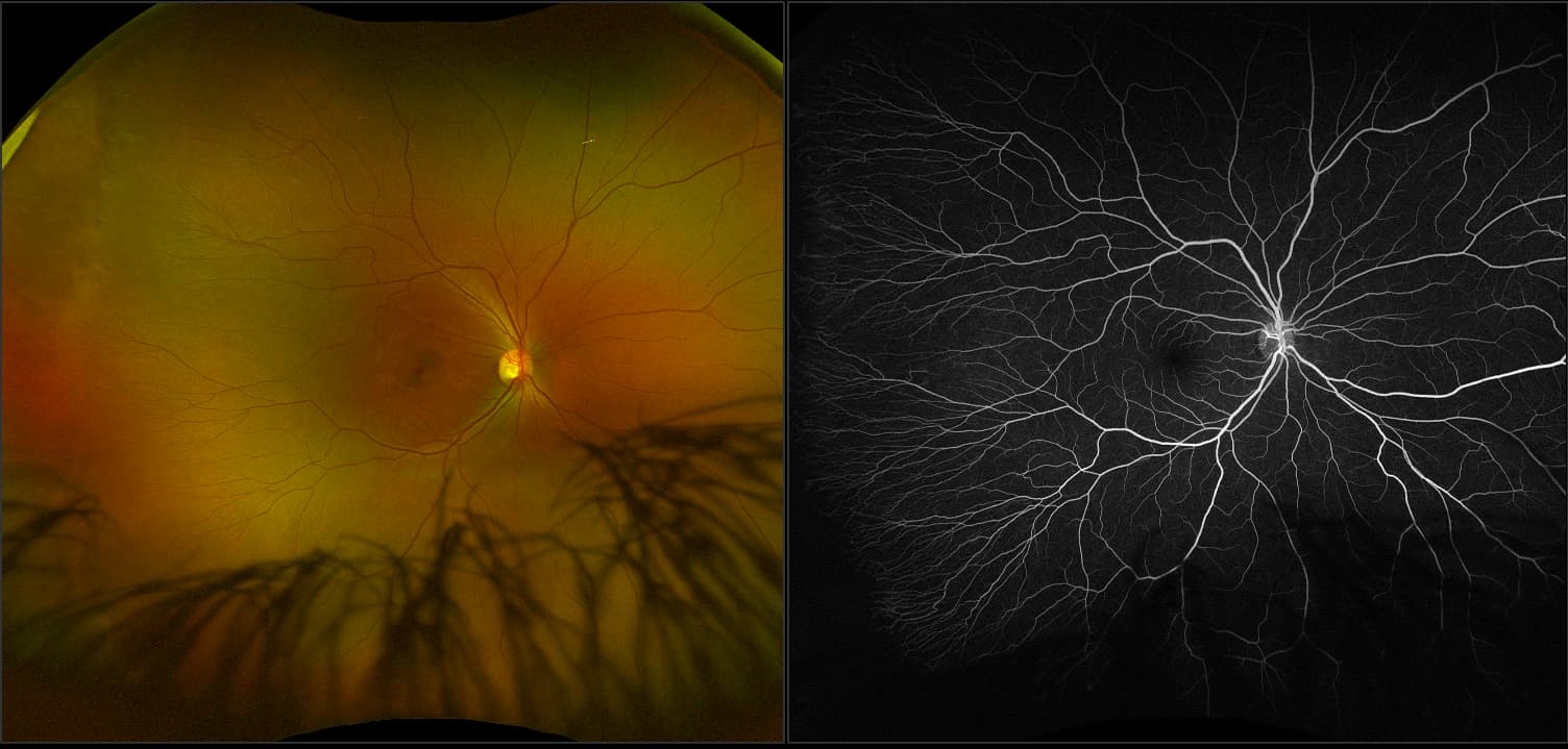 California - Retinopathy of Prematurity with Brushed Boarders, RG, FA