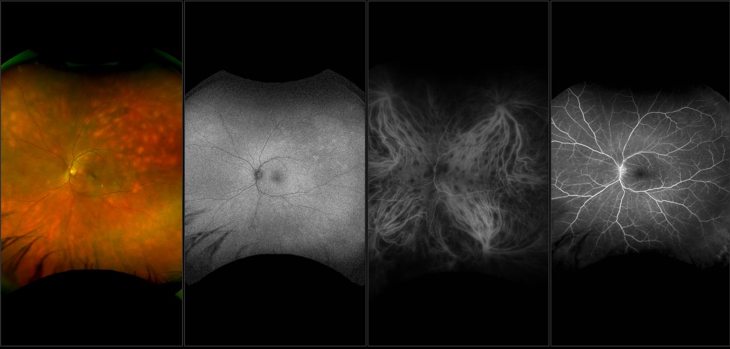 California - Multifocal Birdshot Chorioretinopathy, RG, AF, AF, ICG