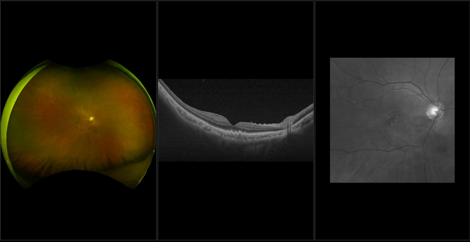 Silverstone - Dry AMD with ERM, RG, OCT