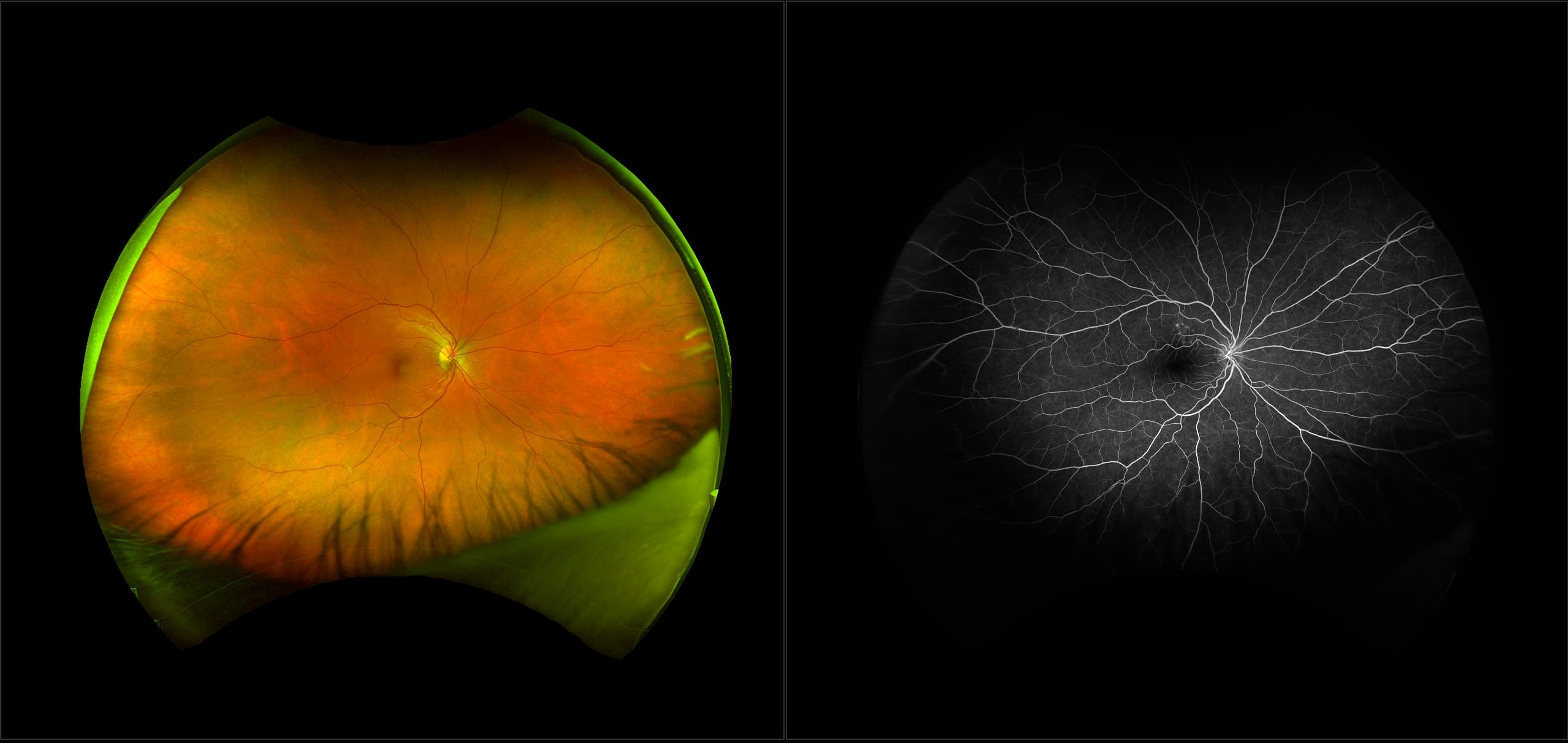 California - Lyme Retinopathy, RG, FA