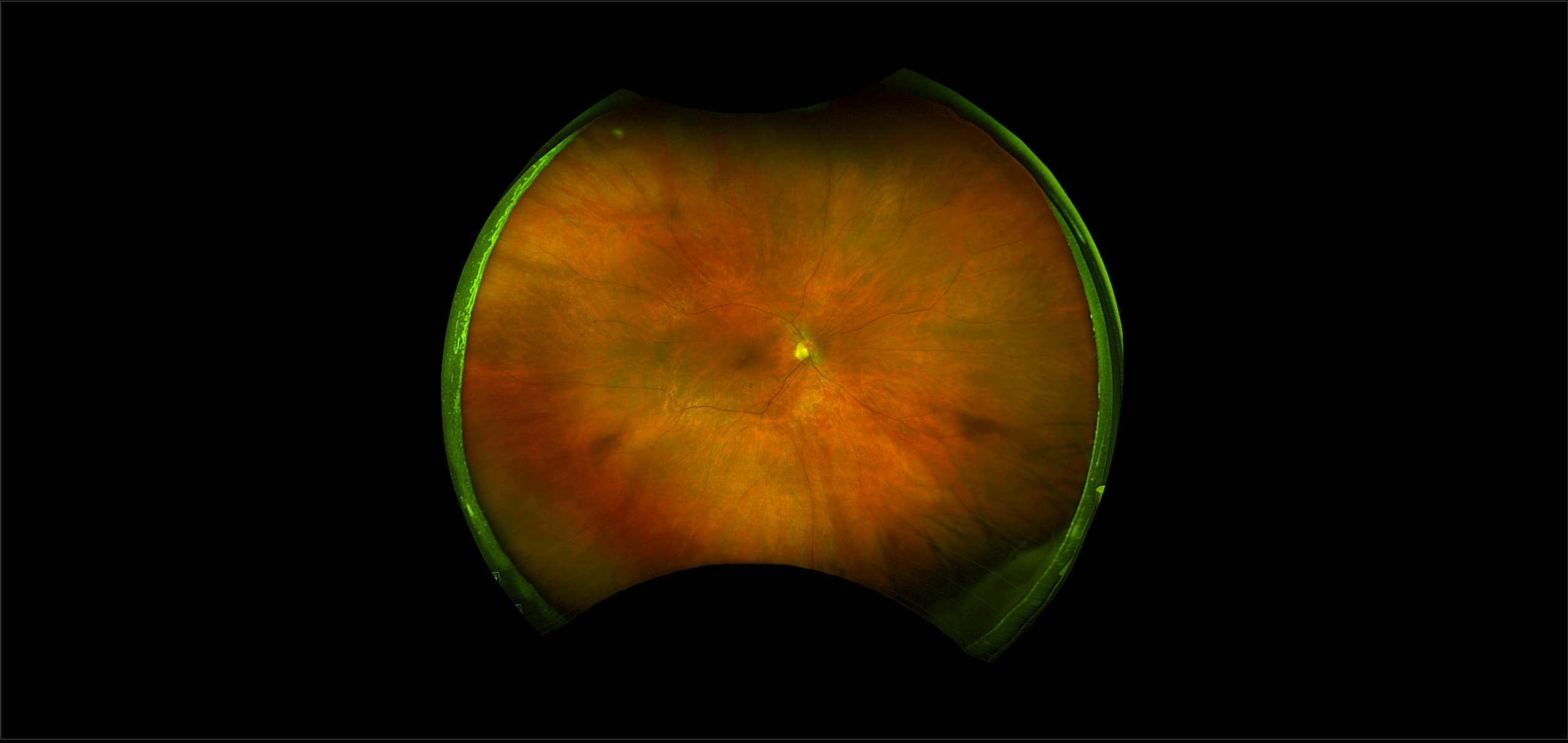 California - Retinal Detachment with Superior Macula-Off, RG