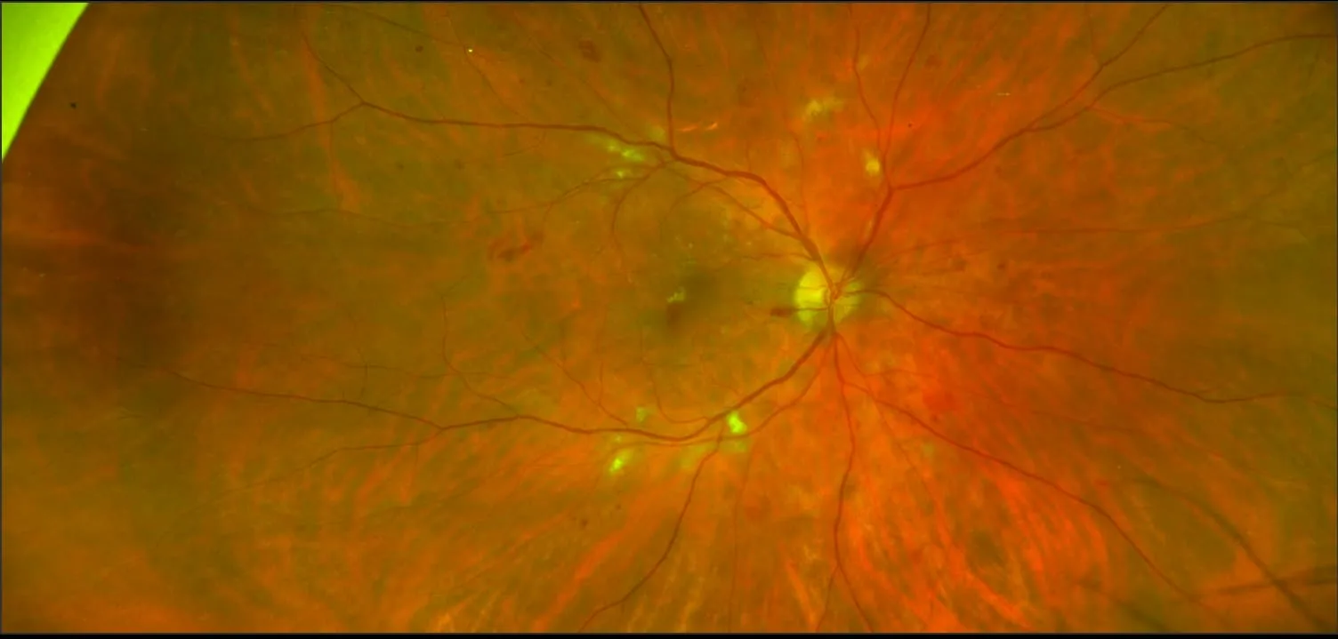 California - Diabetic Retinopathy, RG