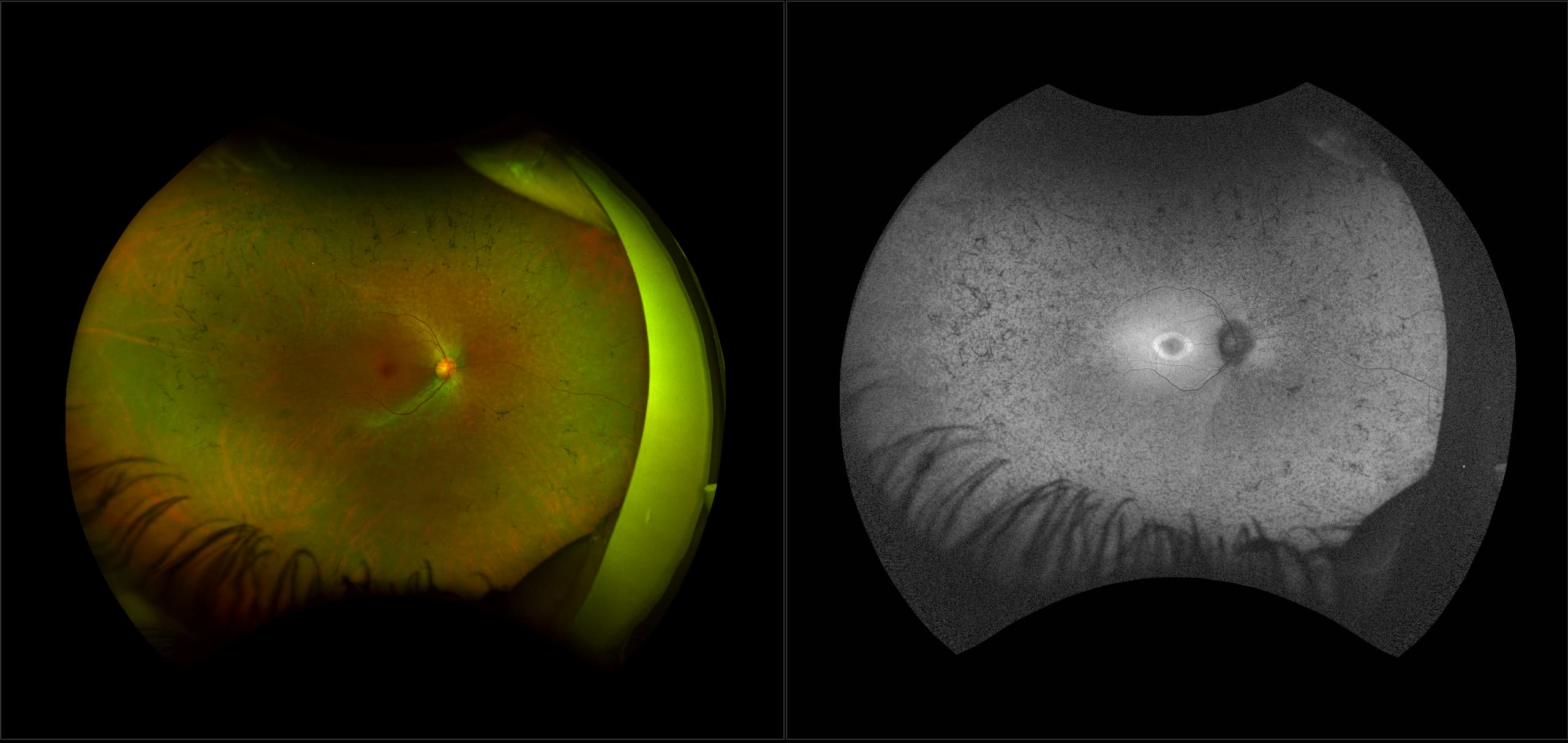 California - Retinitis Pigmentosa with Birdshot Retinopathy, RG, AF