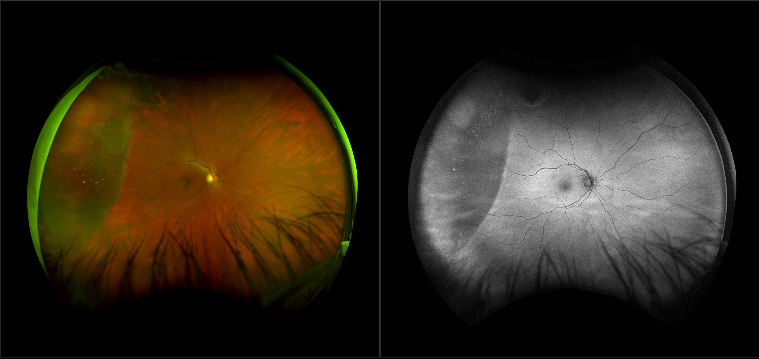 California - Retinal Detachment with Horseshoe Tear, RG, AF