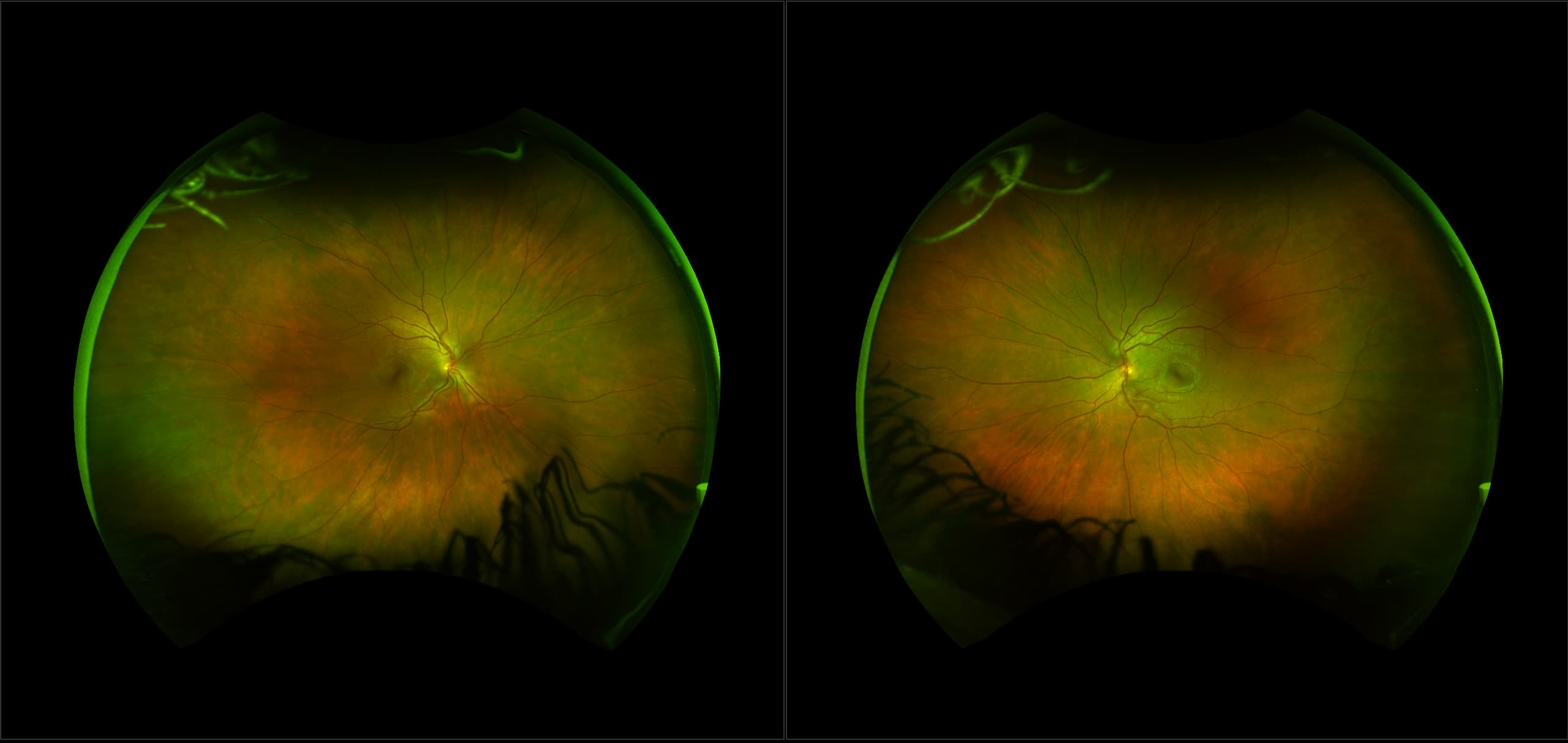 California - Mild Non-Proliferative Diabetic Retinopathy, RG