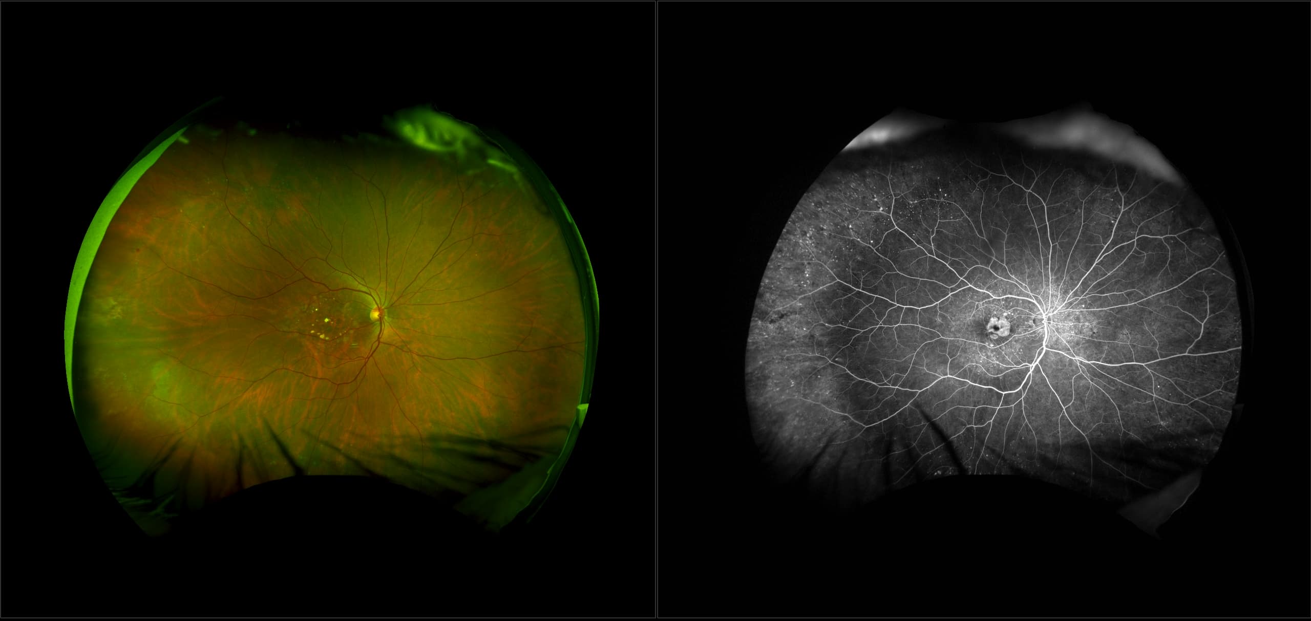 California - Wet AMD with Non-Proliferative Diabetic Retinopathy, RG, FA