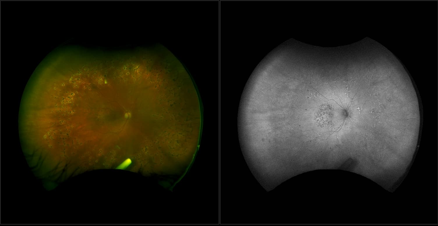 California - Diabetic Macular Edema with Ozurex Implant, RG, AF