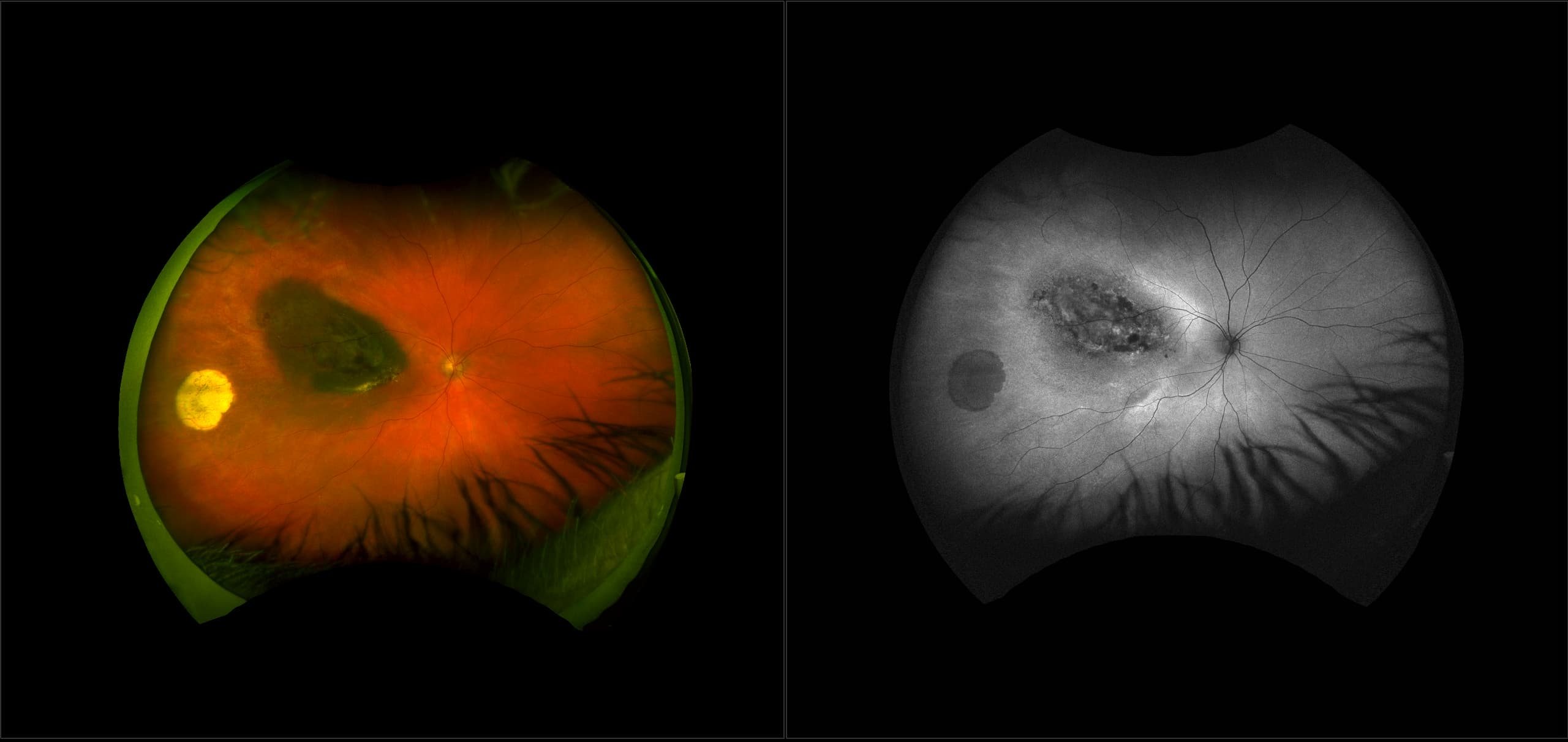 California - Malignant Melanoma with Brachytherapy, RG, AF