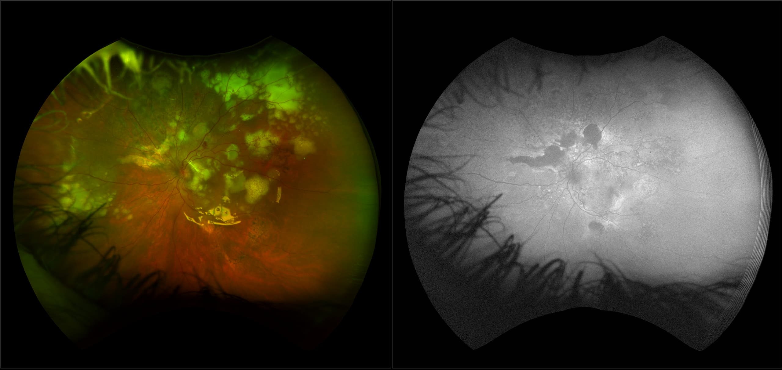 California - Lymphoma, RG, AF