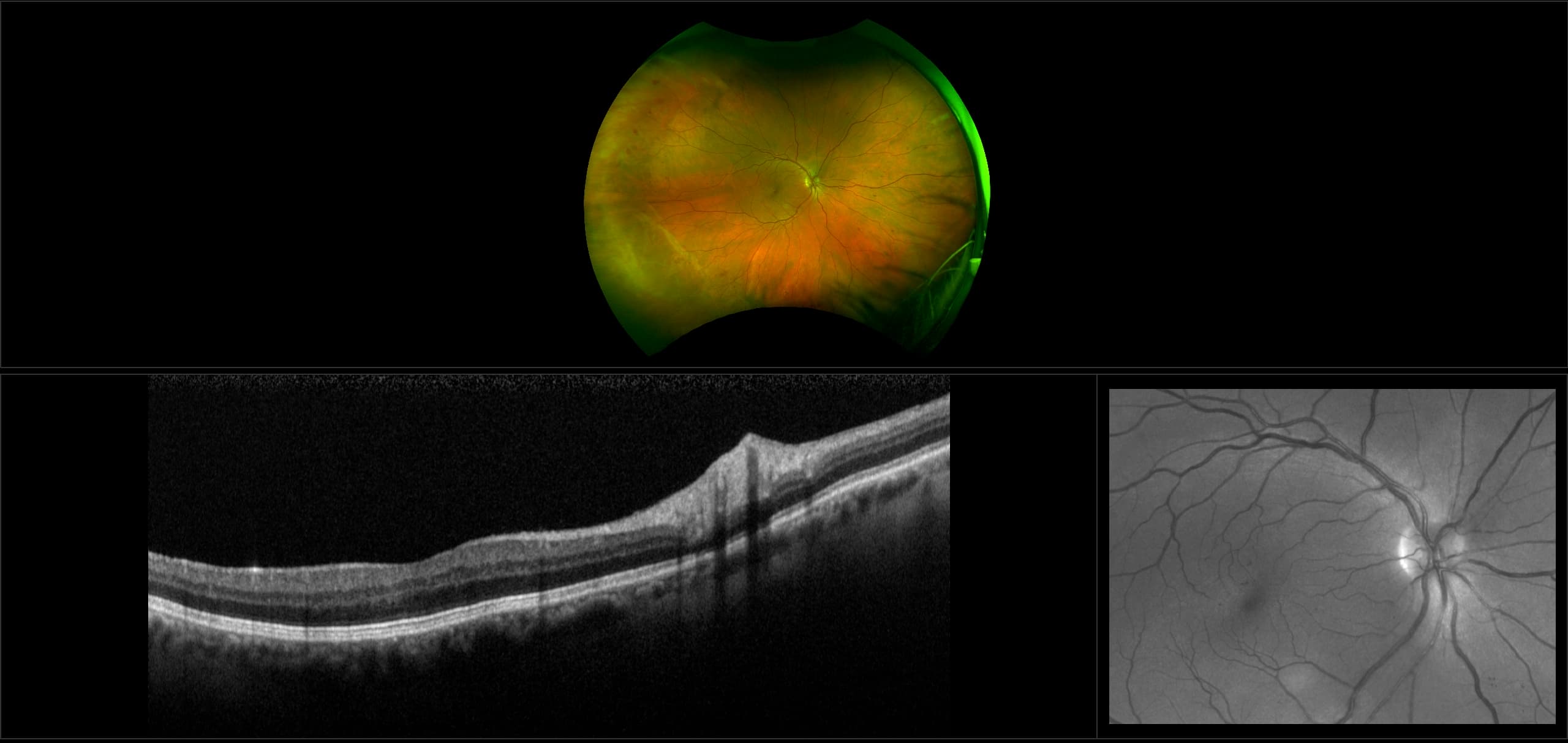 Monaco - Non-Proliferative Diabetic Retinopathy with PPL, RG, OCT