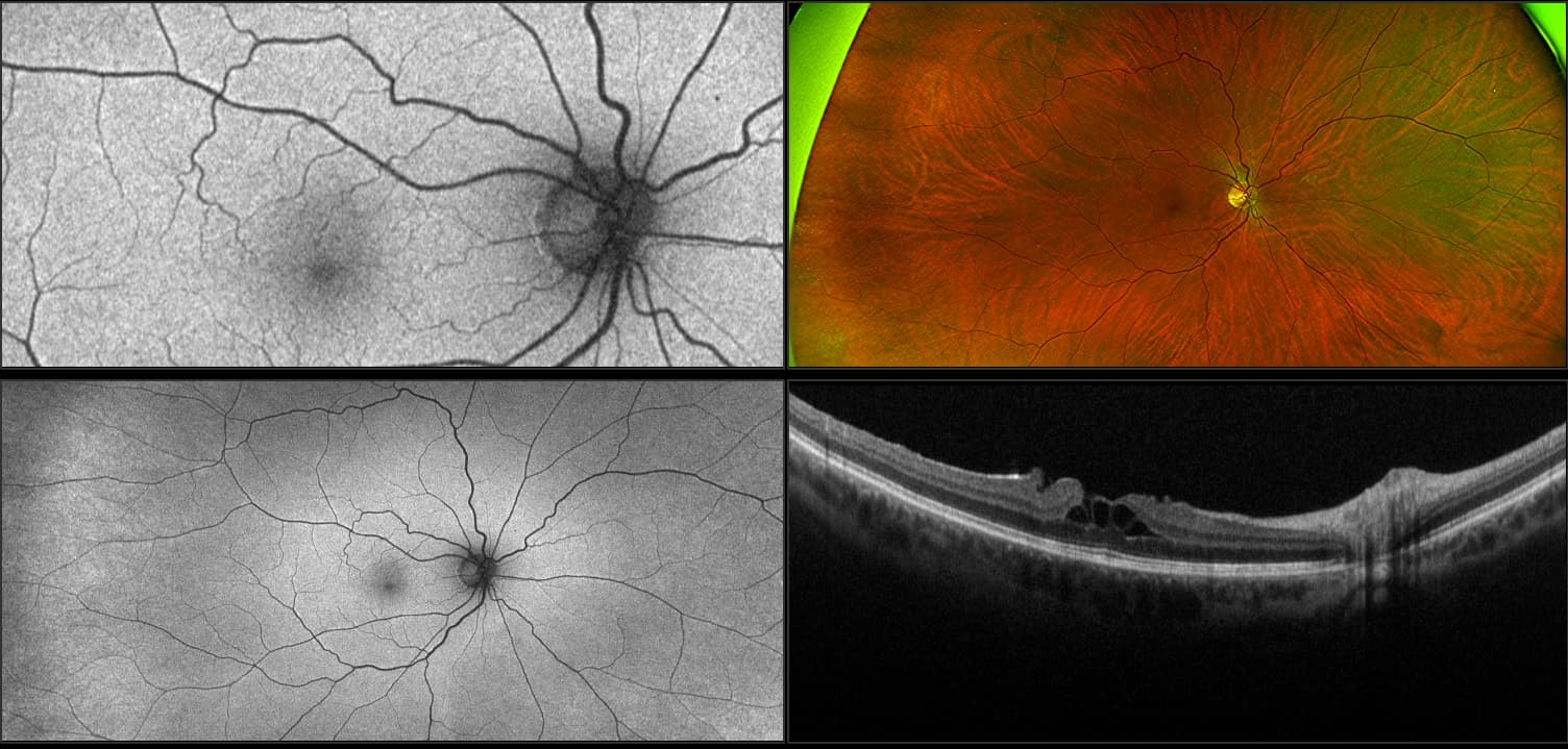 Monaco - Pseudo Macular Hole, RG, AF, OCT