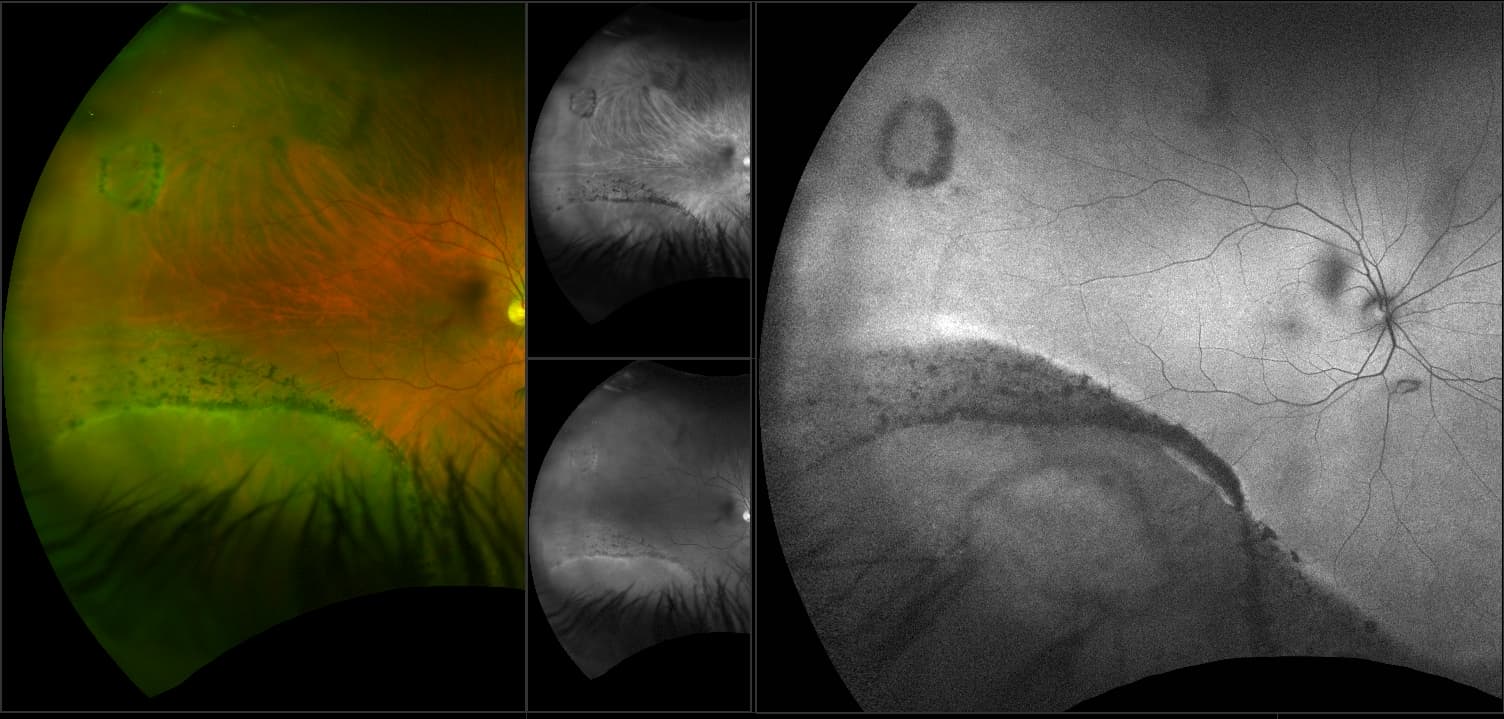 Monaco - Retinal Detachment, RG, AF, OCT