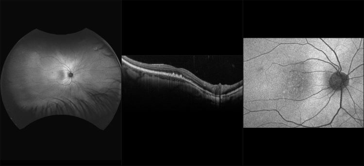 Monaco - Early AMD with Drusen, RG, AF, OCT