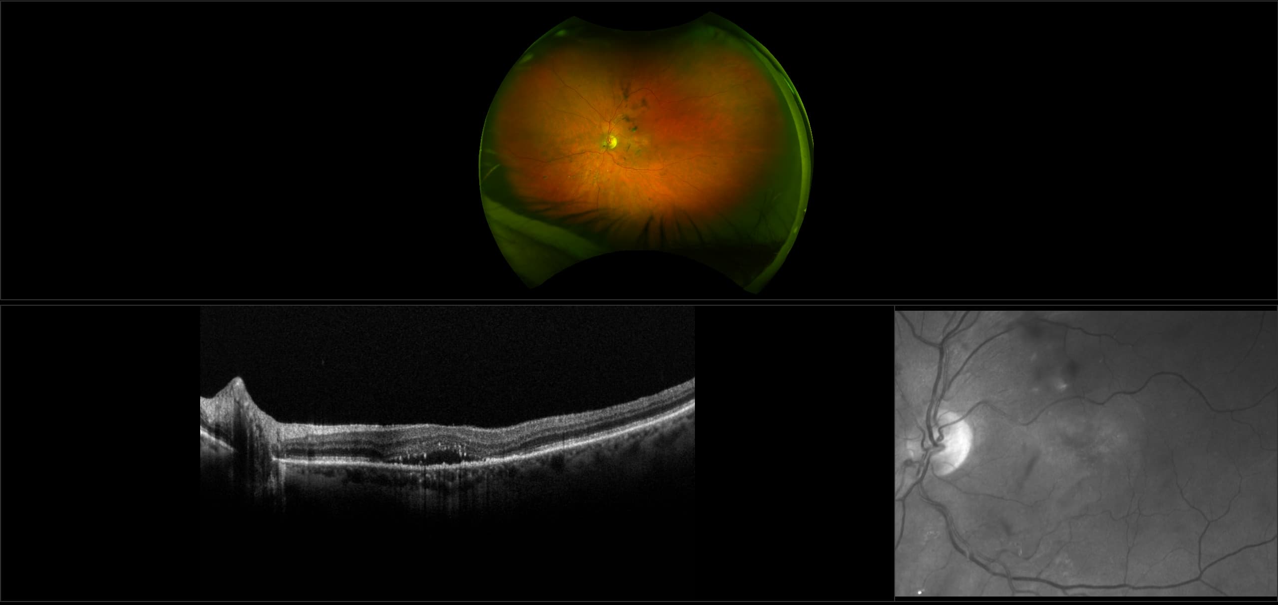 Monaco - Dry AMD with Macular Edema, RG, OCT