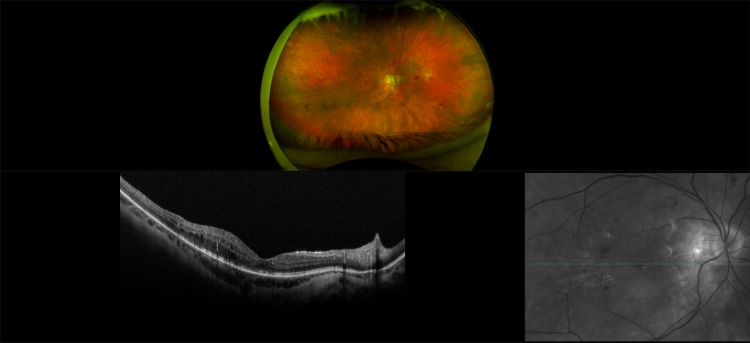 Monaco - Diabetic Retinopathy with Macular Edema, RG, OCT