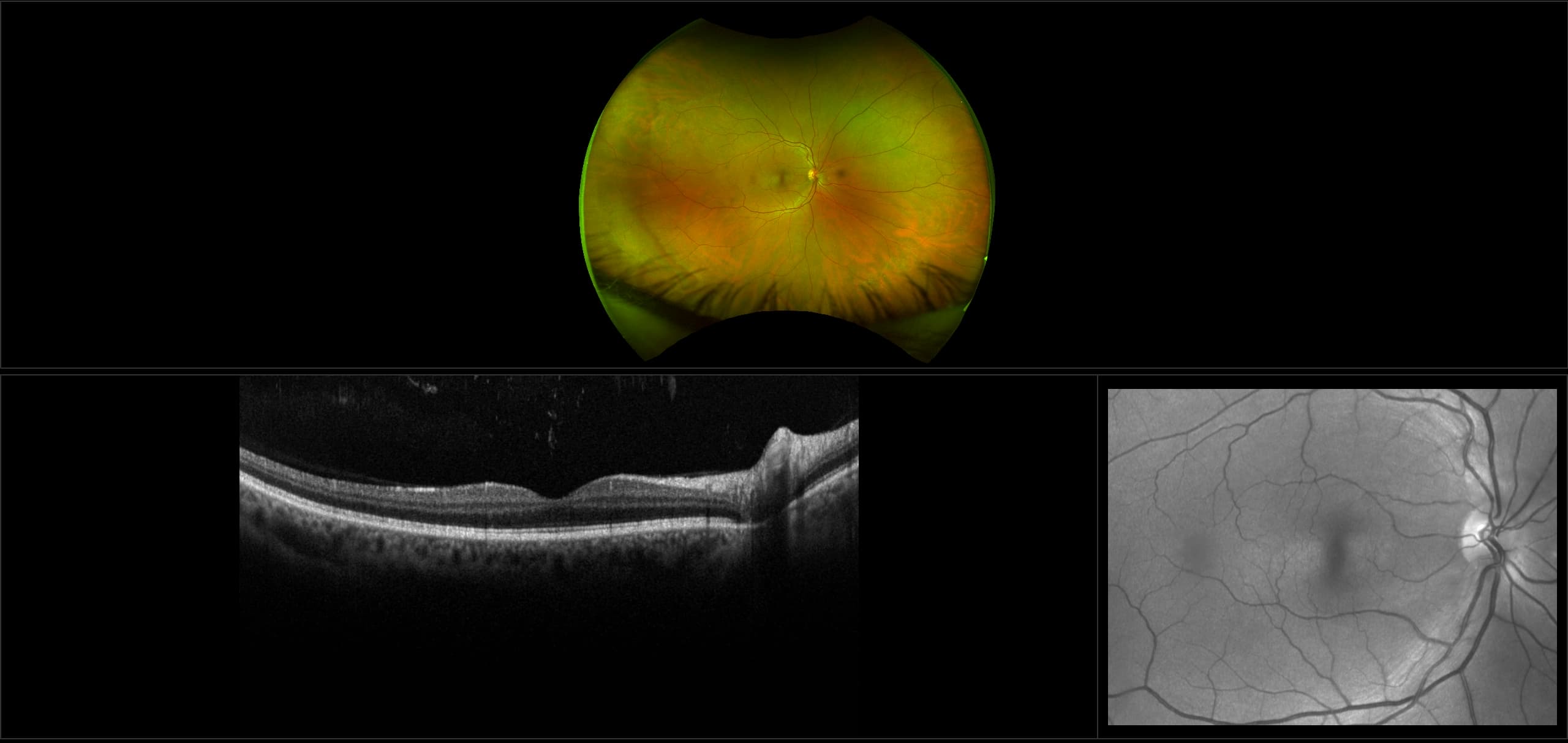 Monaco - Vitreous Floaters, RG, OCT