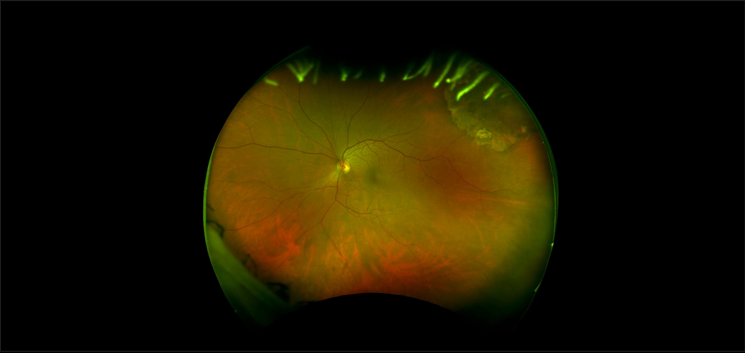 Monaco - Peripheral Atrophy, RG