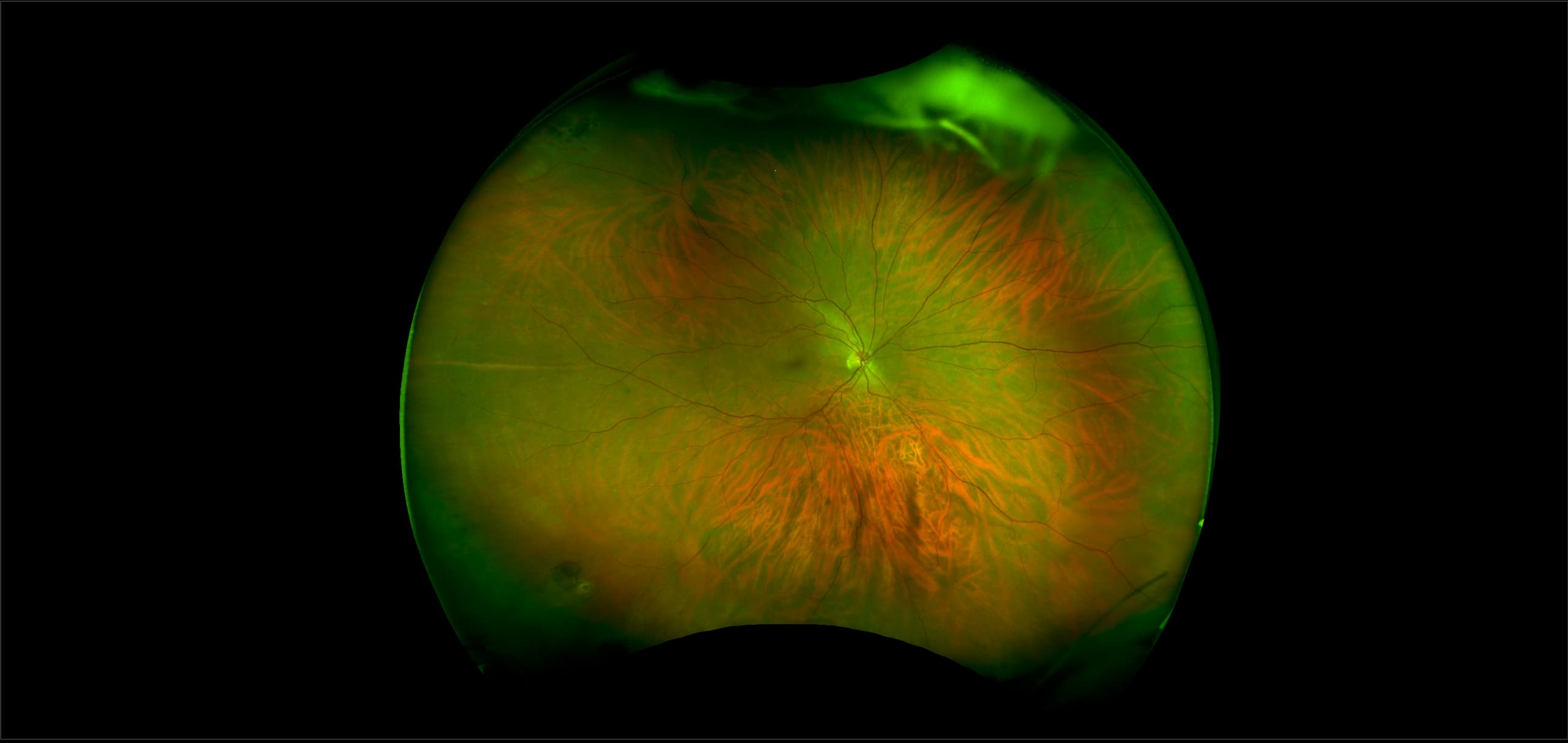 Monaco - Retinal Hole, RG