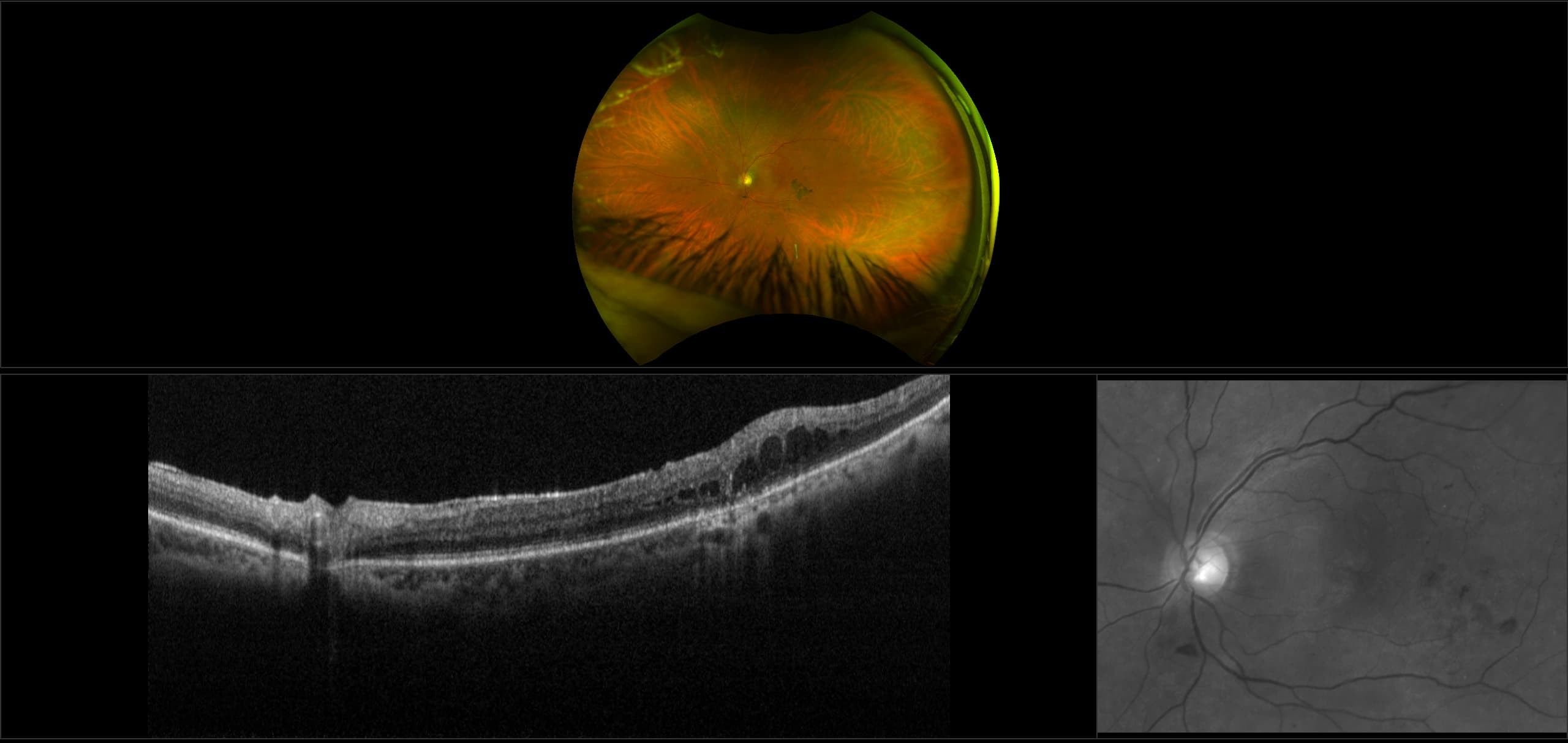 Monaco - Diabetic Macular Edema with Ozurex Implant, RG, OCT