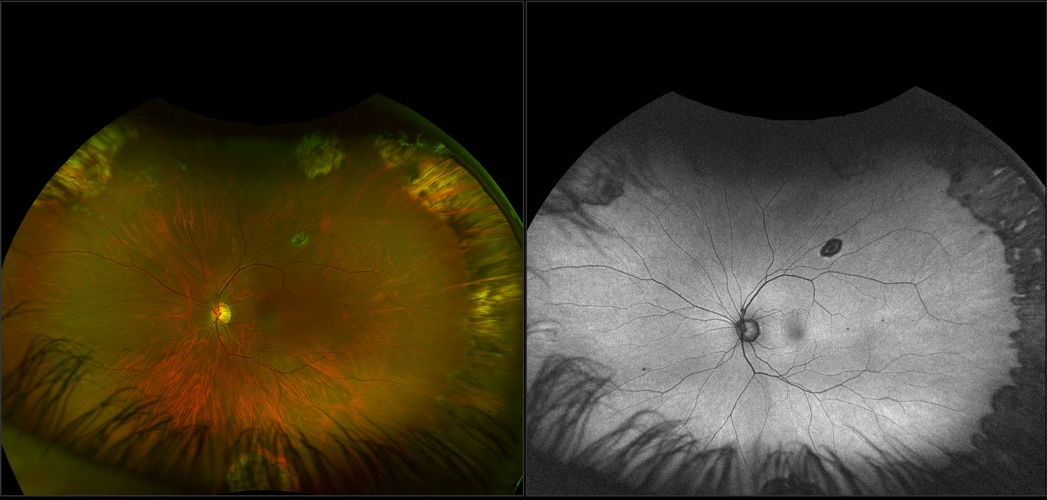 Silverstone - Lattice Degeneration with Retinal Break (repaired), RG, AF, OCT