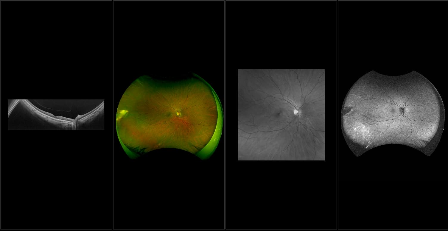 Silverstone - Choroidal Rupture with Vitreous Hemorrhage, RG, AF, OCT