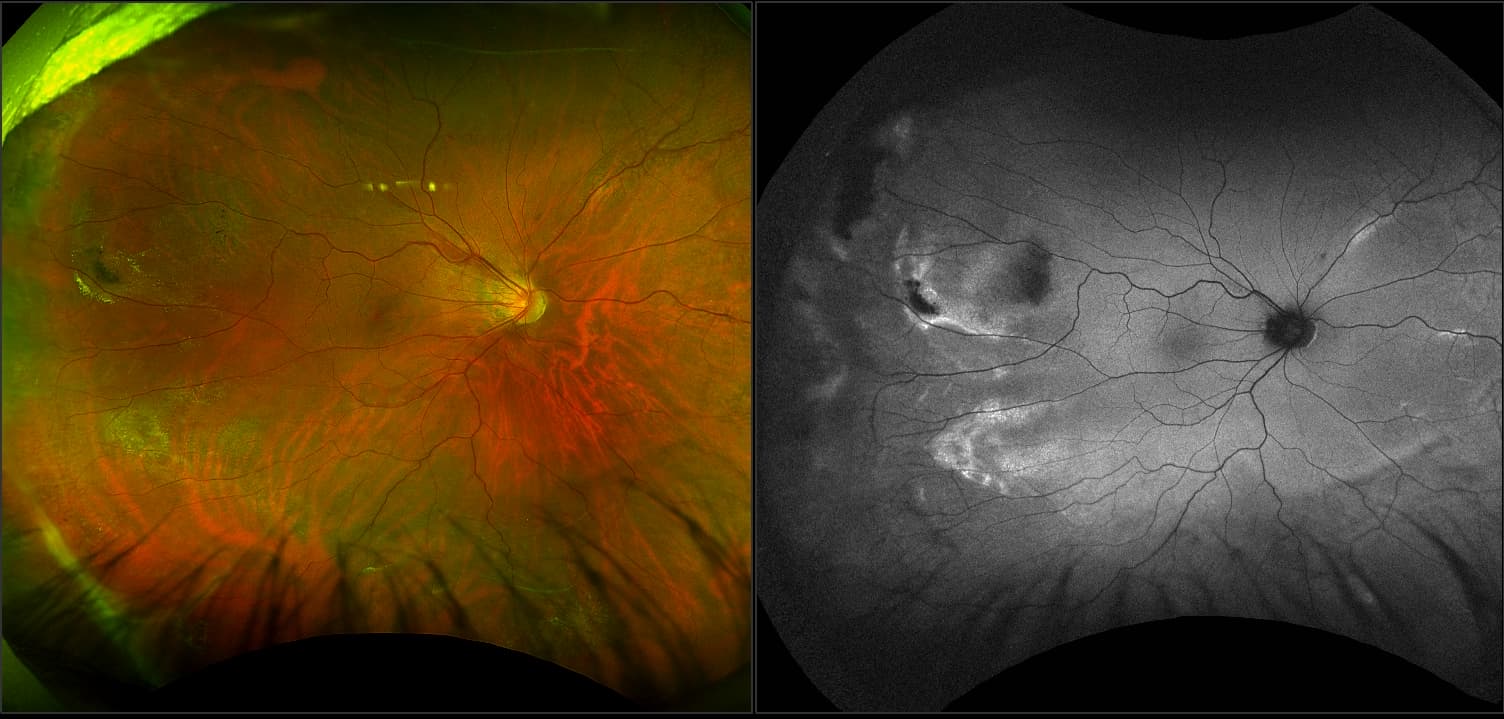 Silverstone - Lattice Degeneration with Retinoschisis, RG, AF, OCT