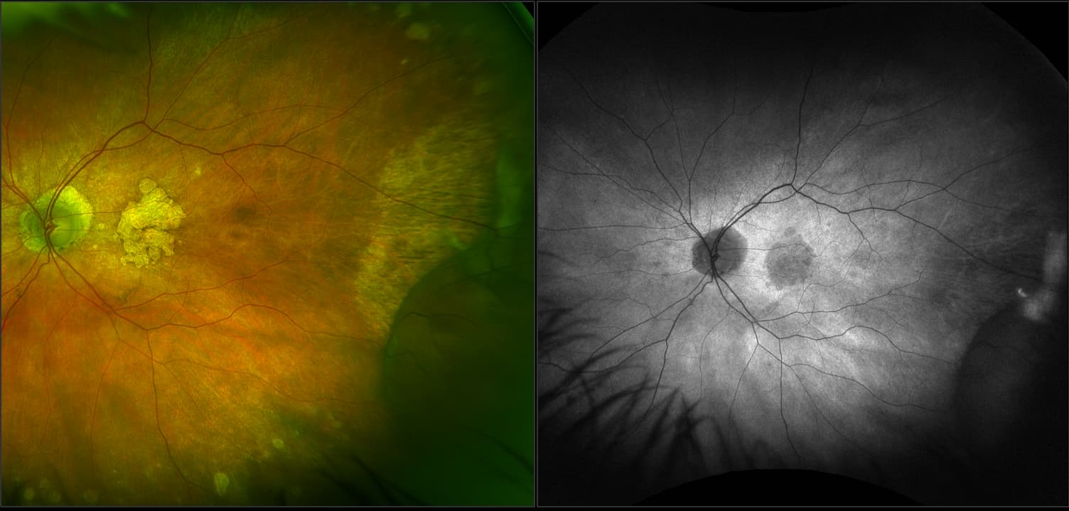 Silverstone - Retinoschisis with Cobblestone Degeneration, RG, AF, OCT