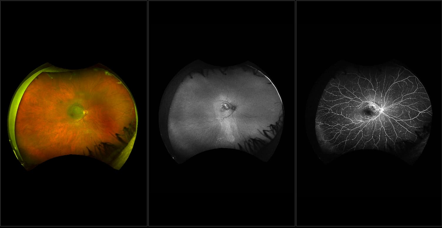 Silverstone - Dry AMD with Neoplasm of the Choroid (benign), RG, FA