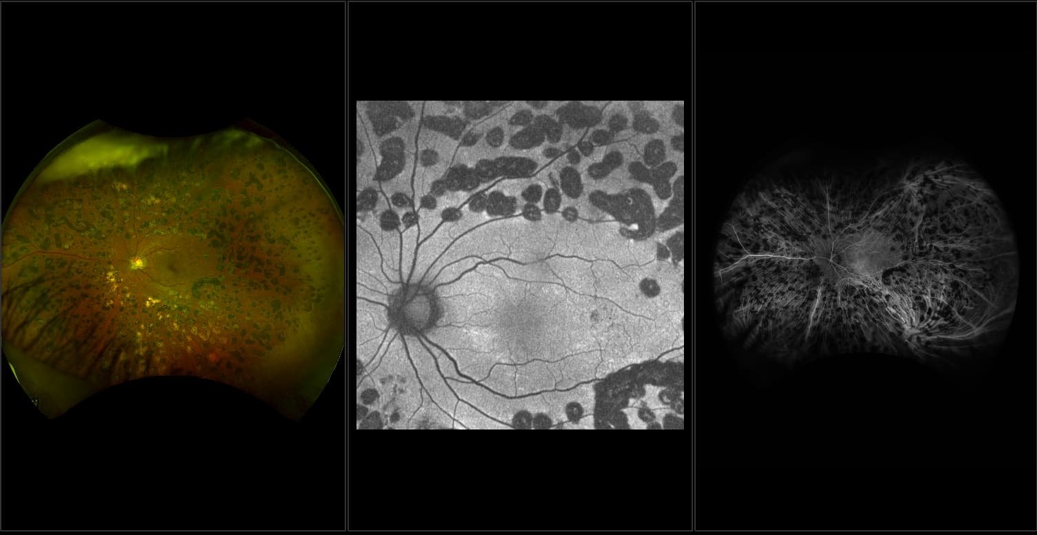 Silverstone - Prolific Diabetic Retinopathy with ERM, RG, ICG