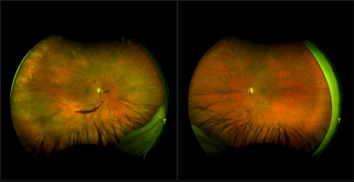 California - Diabetic Retinopathy with PRP, RG