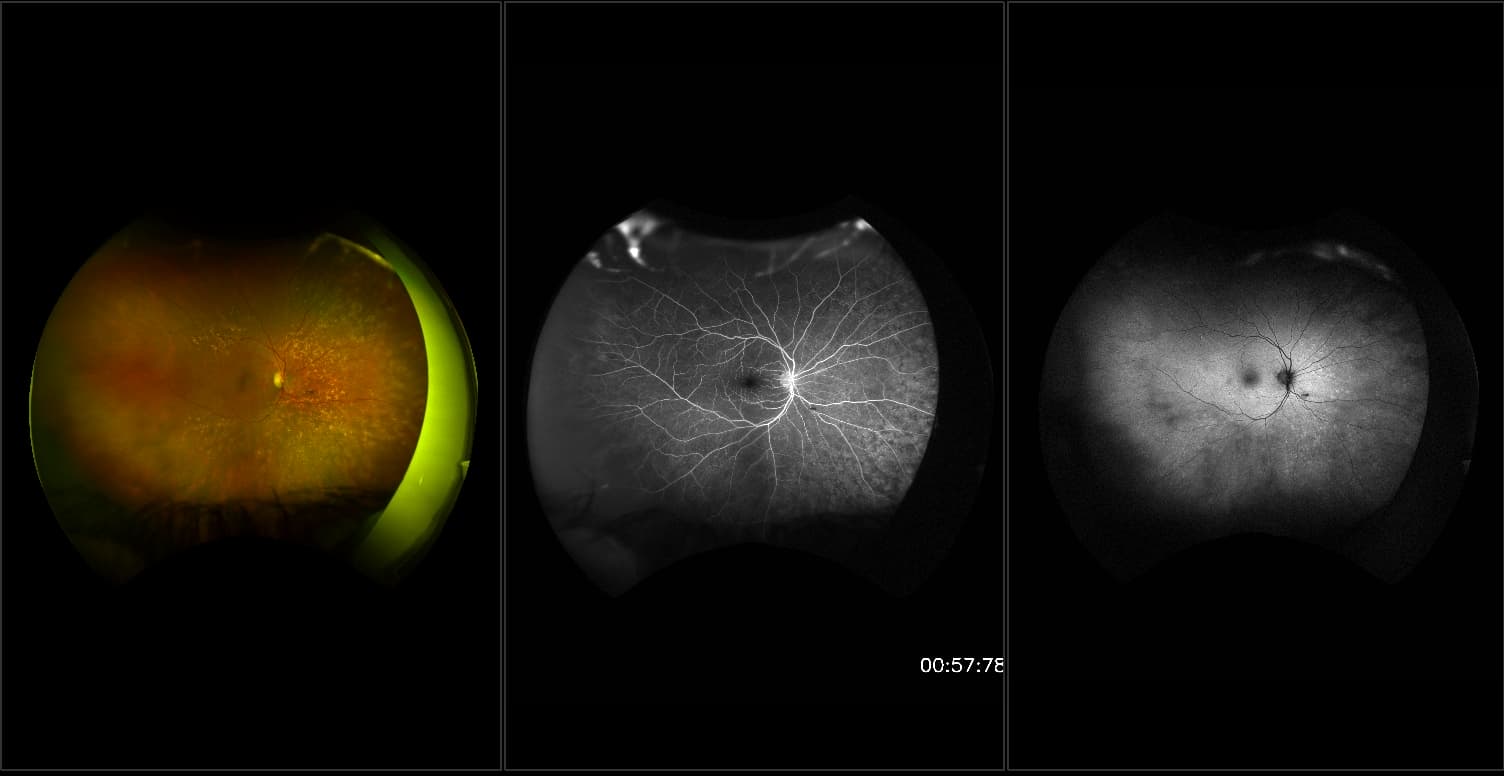 California - Branch Retinal Artery Occlusion, RG, AF, FA