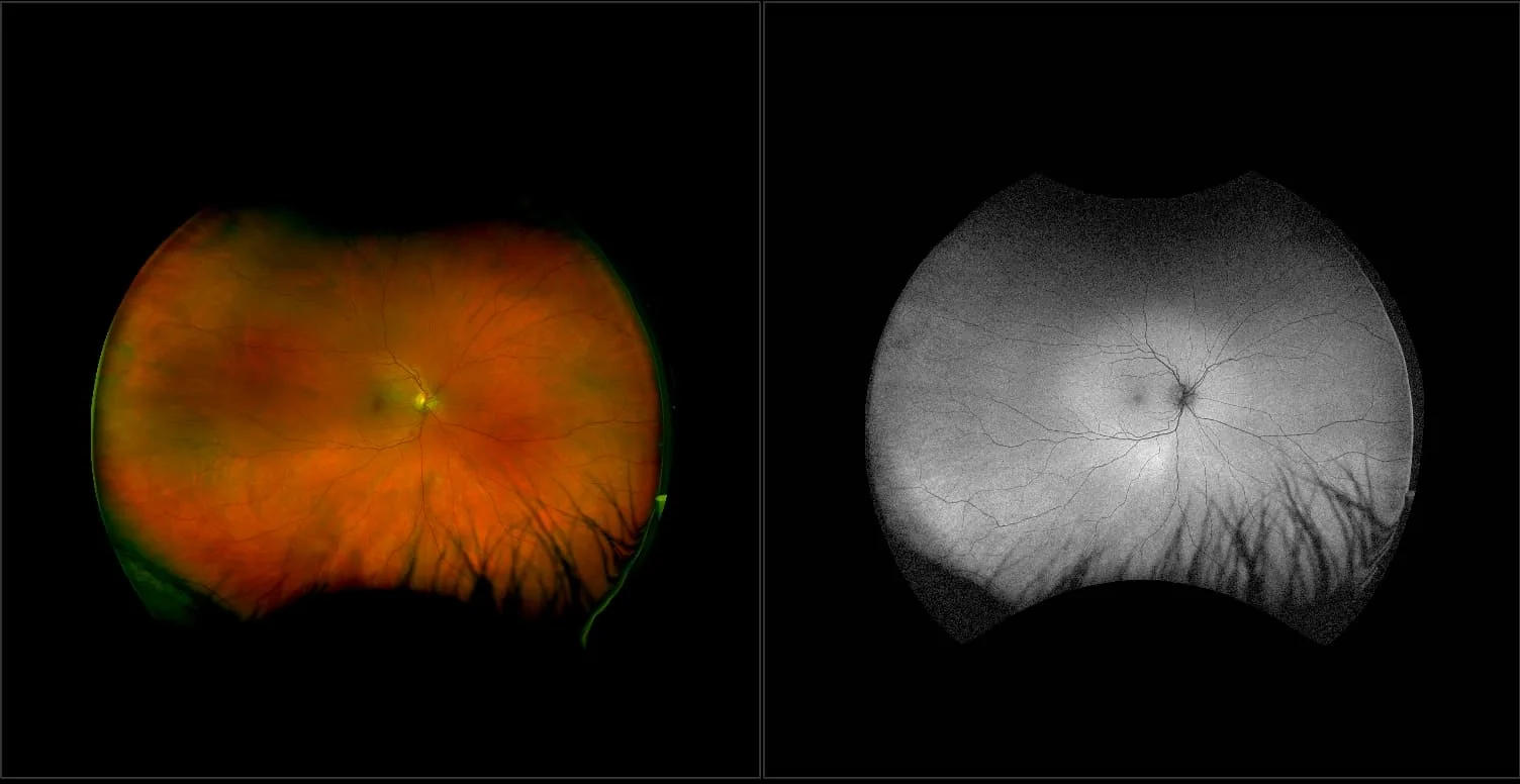 California - Choroidal Nevus, RG, AF
