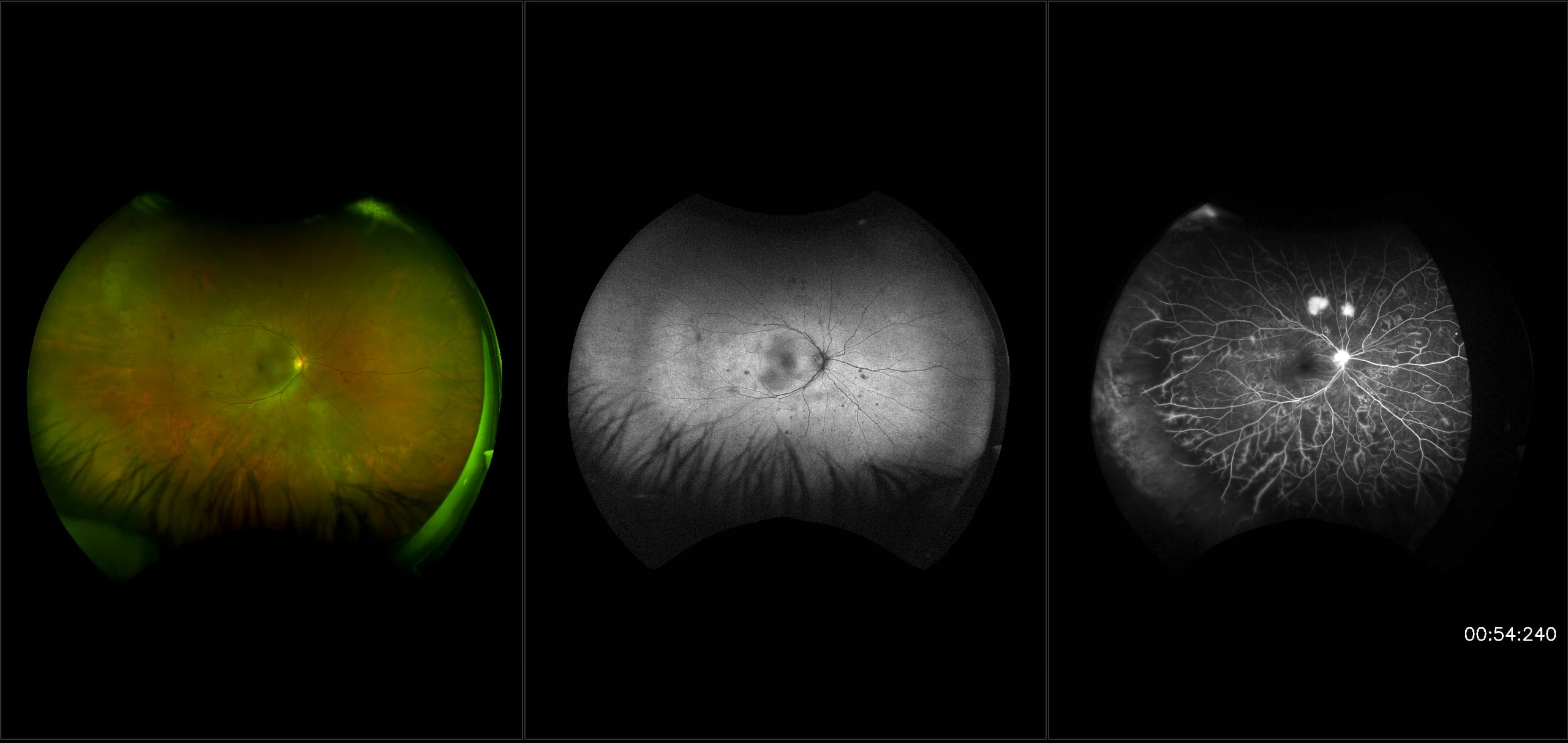 California - Prolific Diabetic Retinopathy, RG, AF, FA