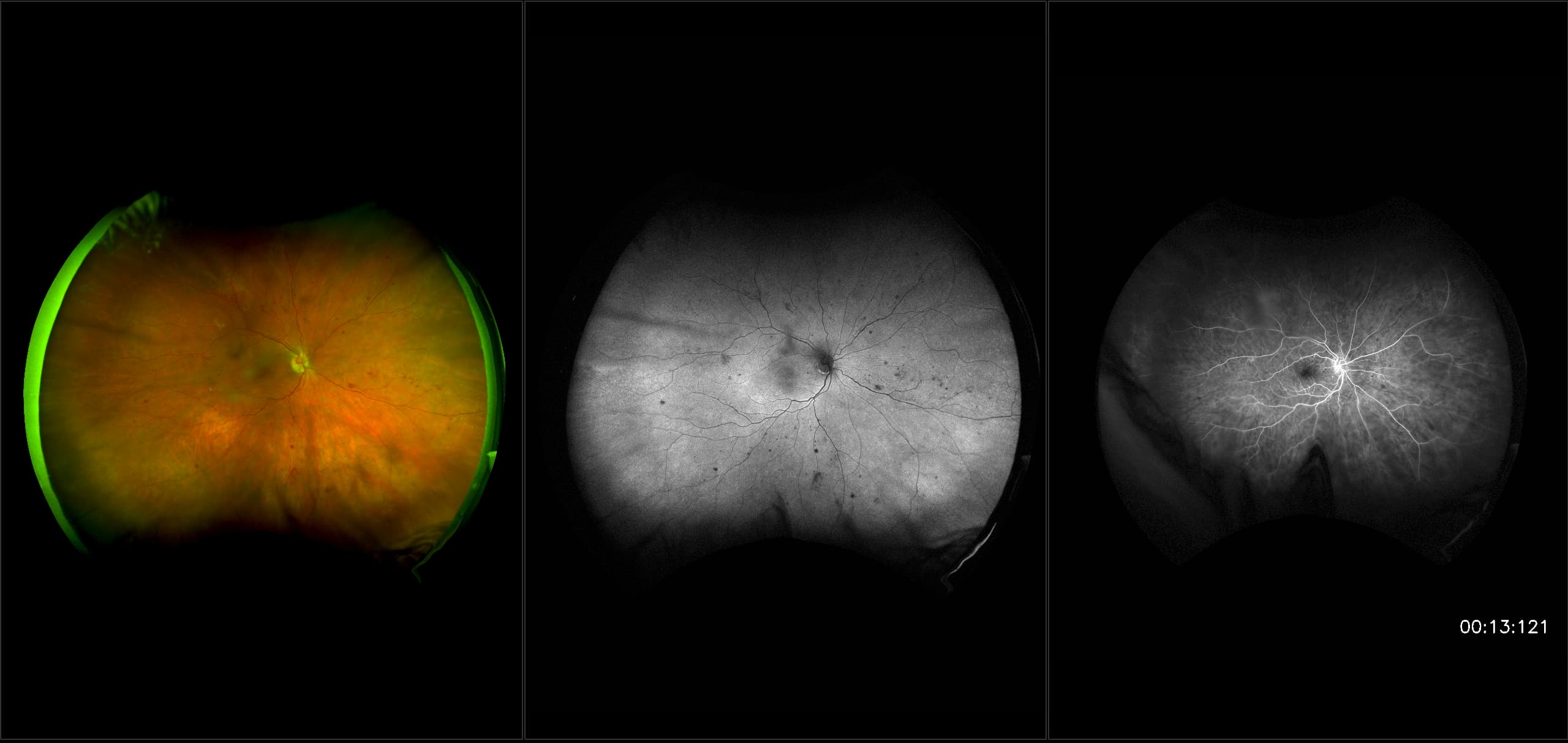 California - Proliferative Diabetic Retinopathy, RG, AF, FA