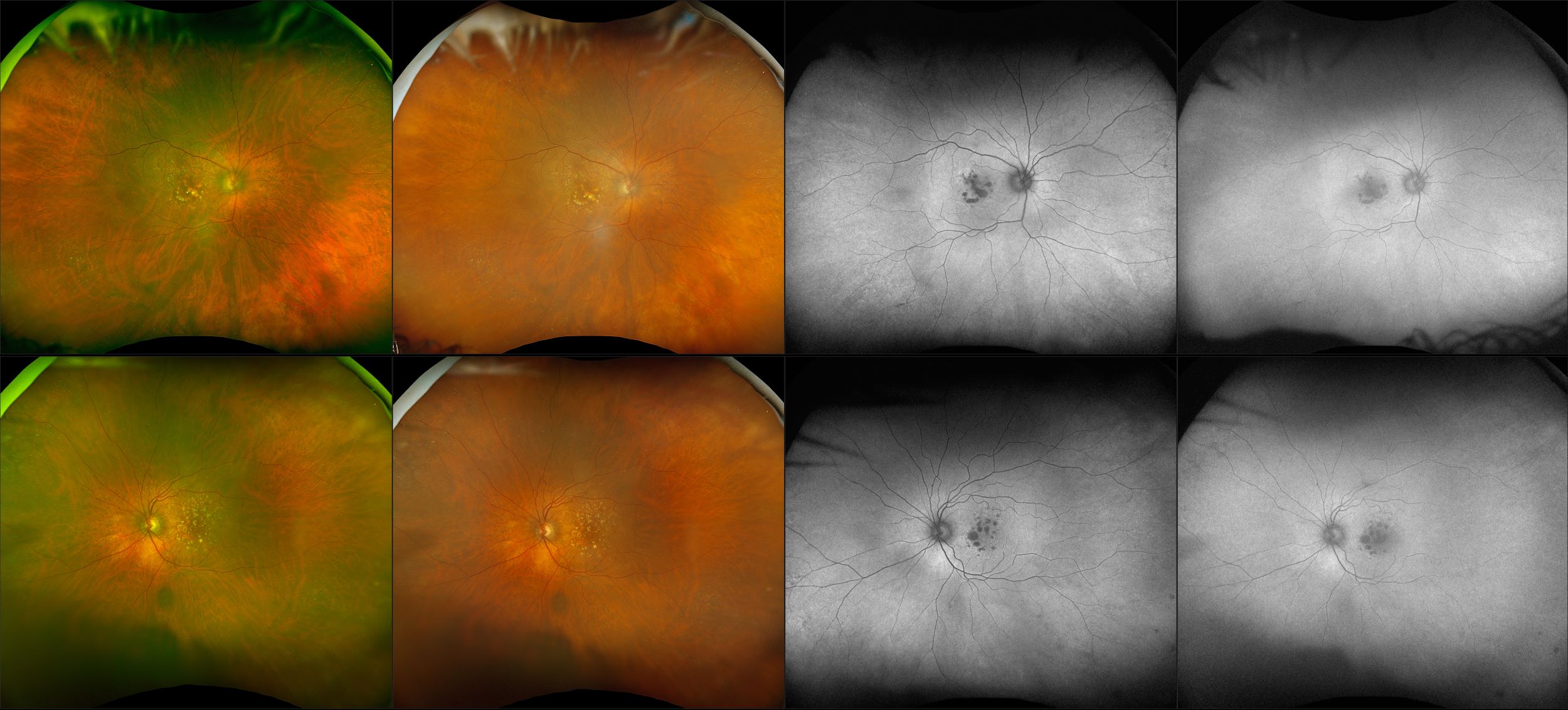 California - Geographic Atrophy, RG, RGB, AF, BAF