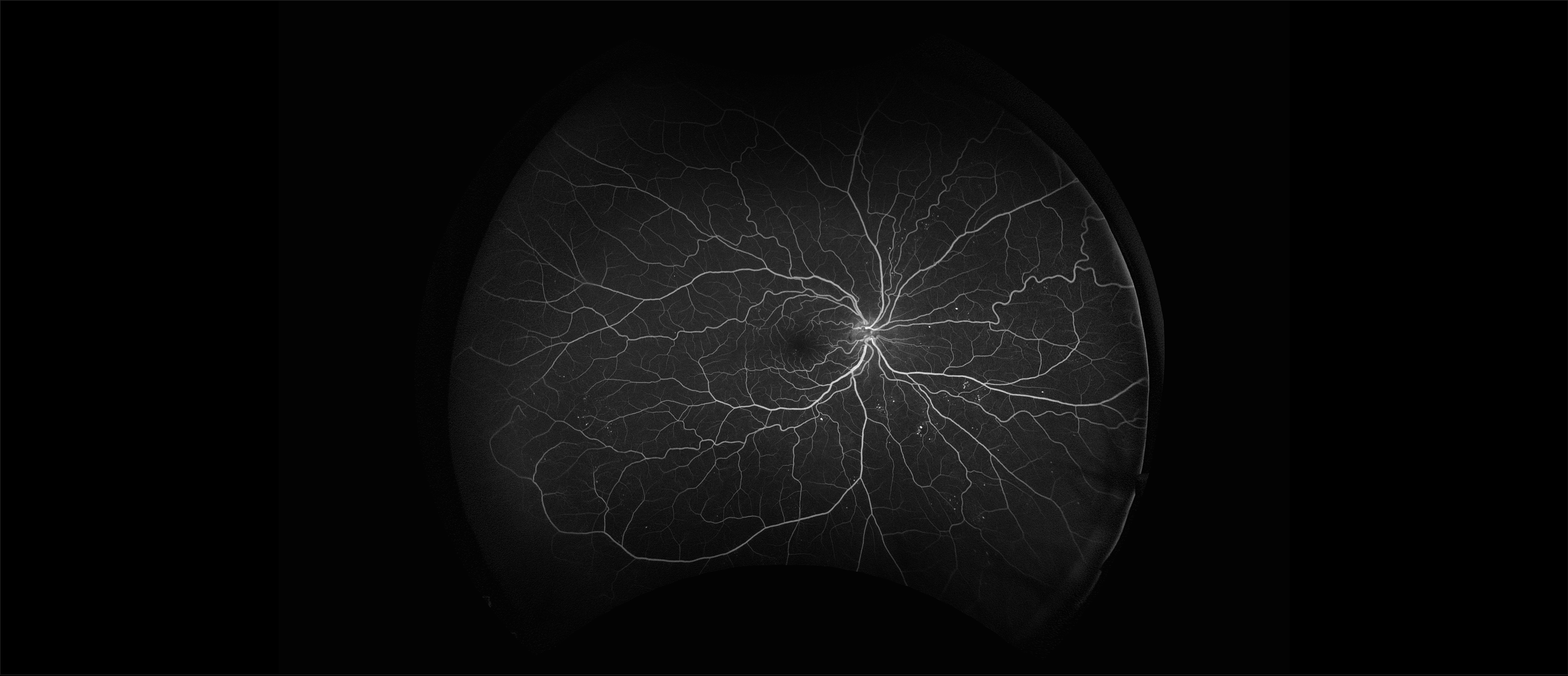 California - Diabetic Retinopathy, FA