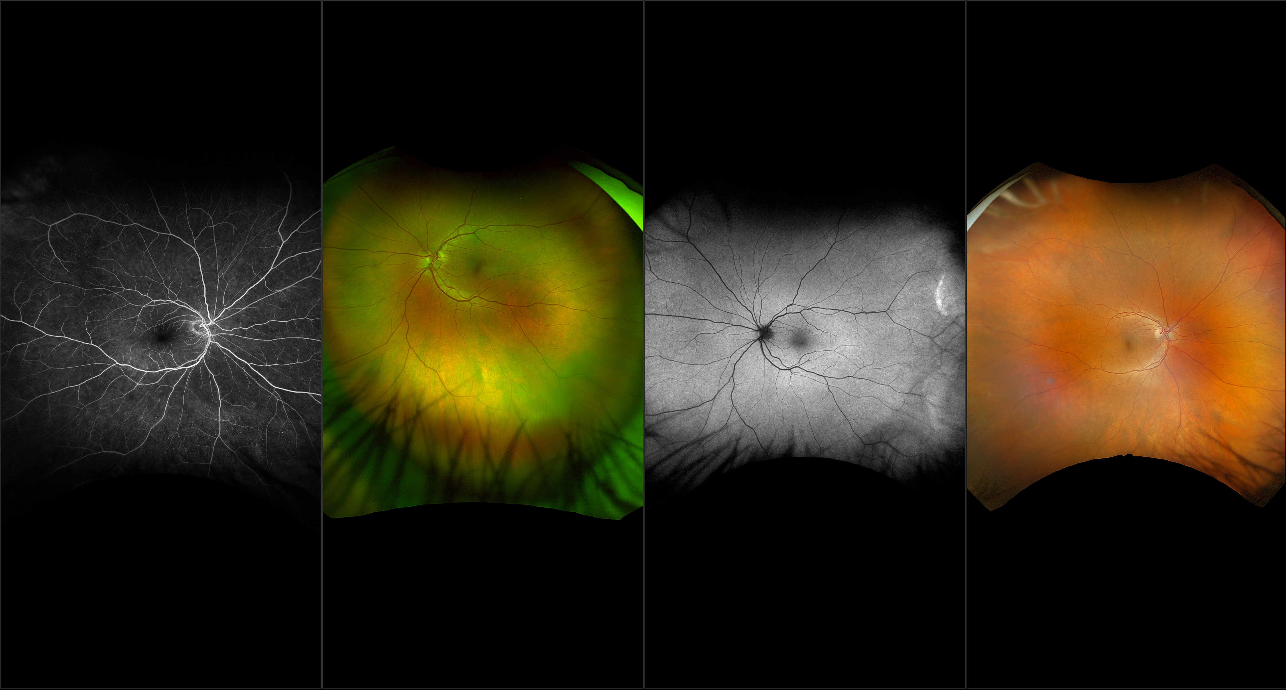 California - Retinoschisis, RG, RGB, AF, FA