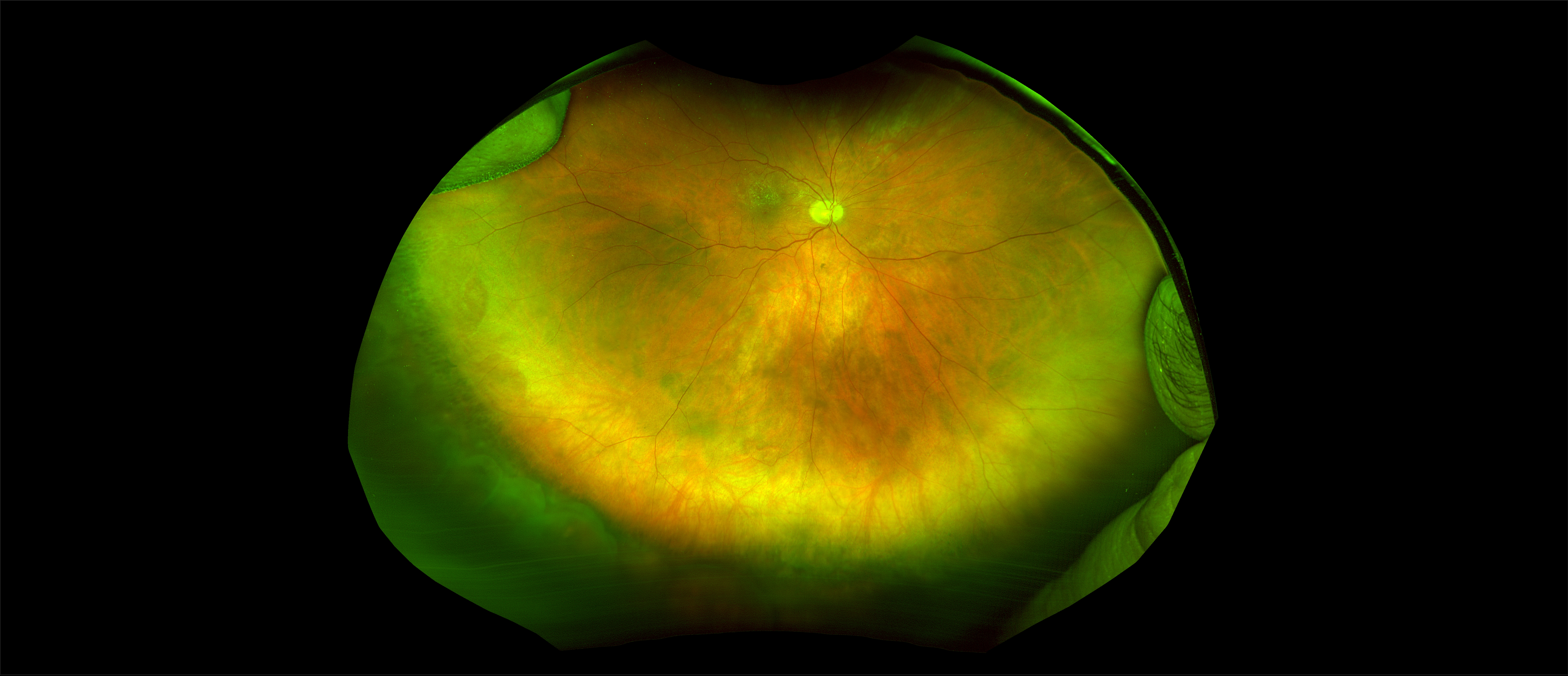 California - Large Pars Plana Cysts - Steered, RG