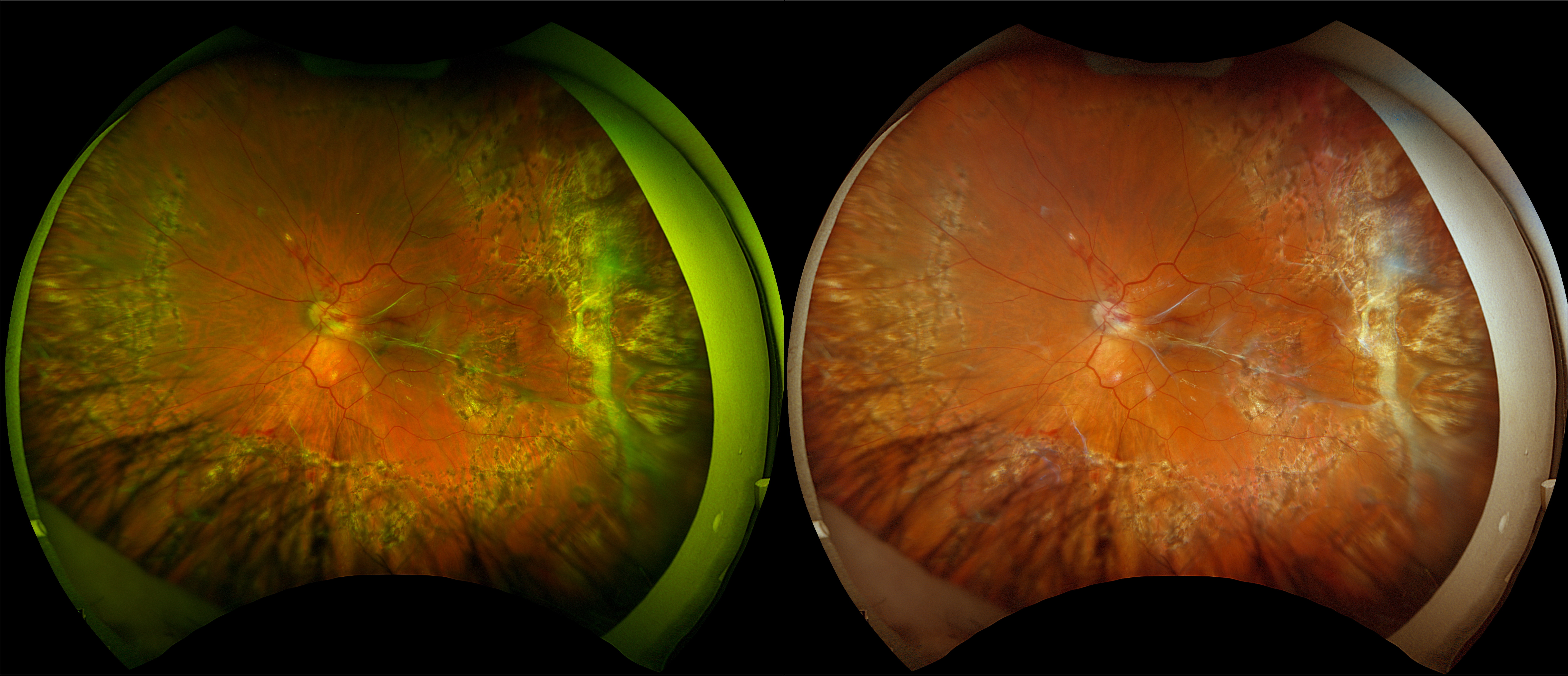 California - Diabetic Retinopathy with Vitreous Traction, RG, RGB