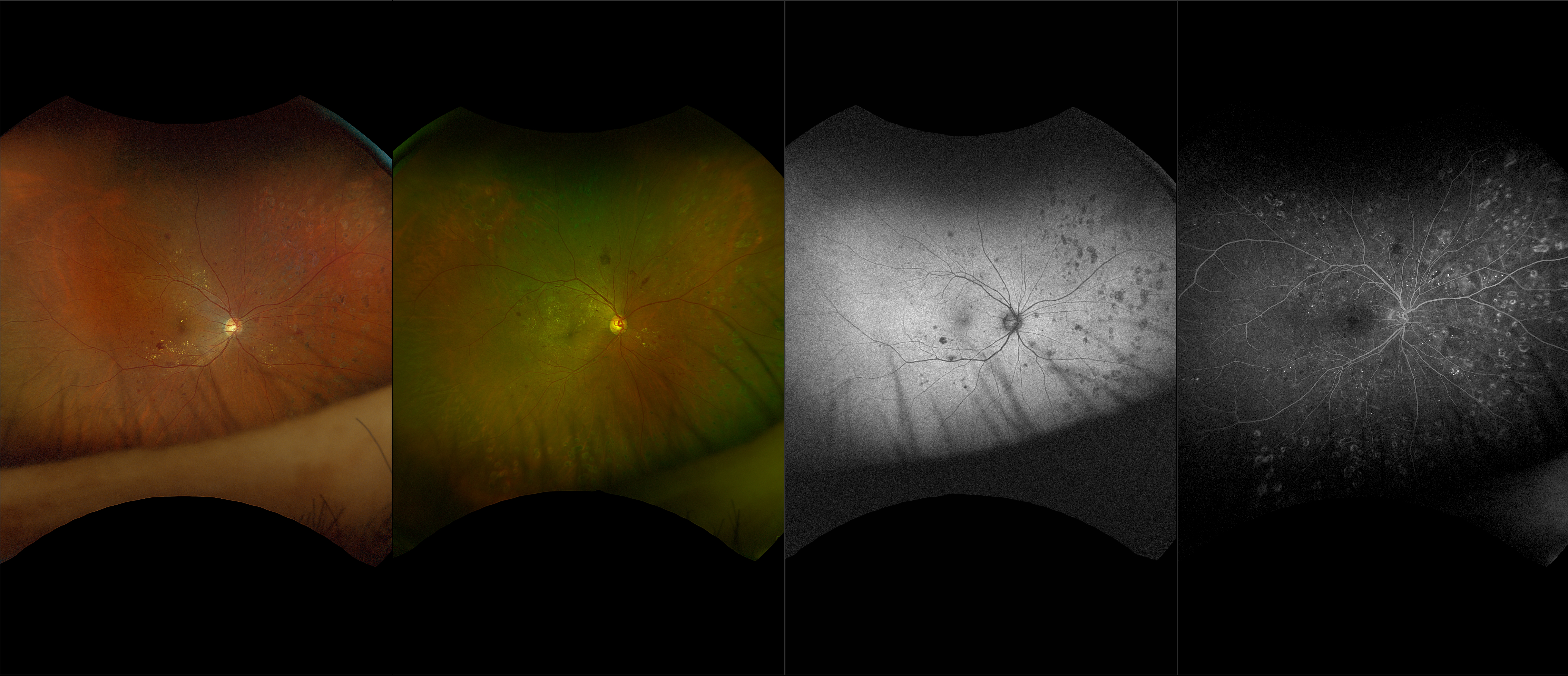 California - Proliferative Diabetic Retinopathy, RG, RGB, AF, FA