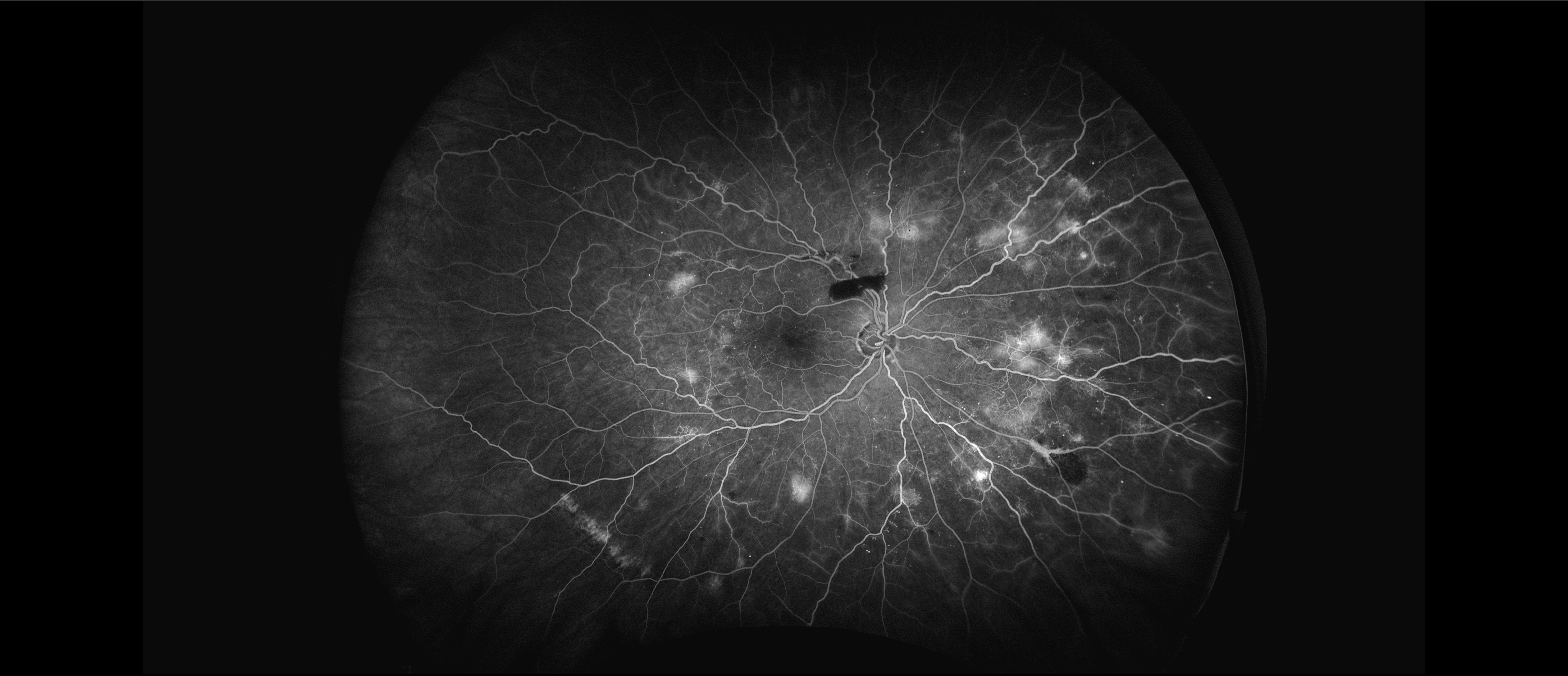 California - Diabetic Retinopathy, FA