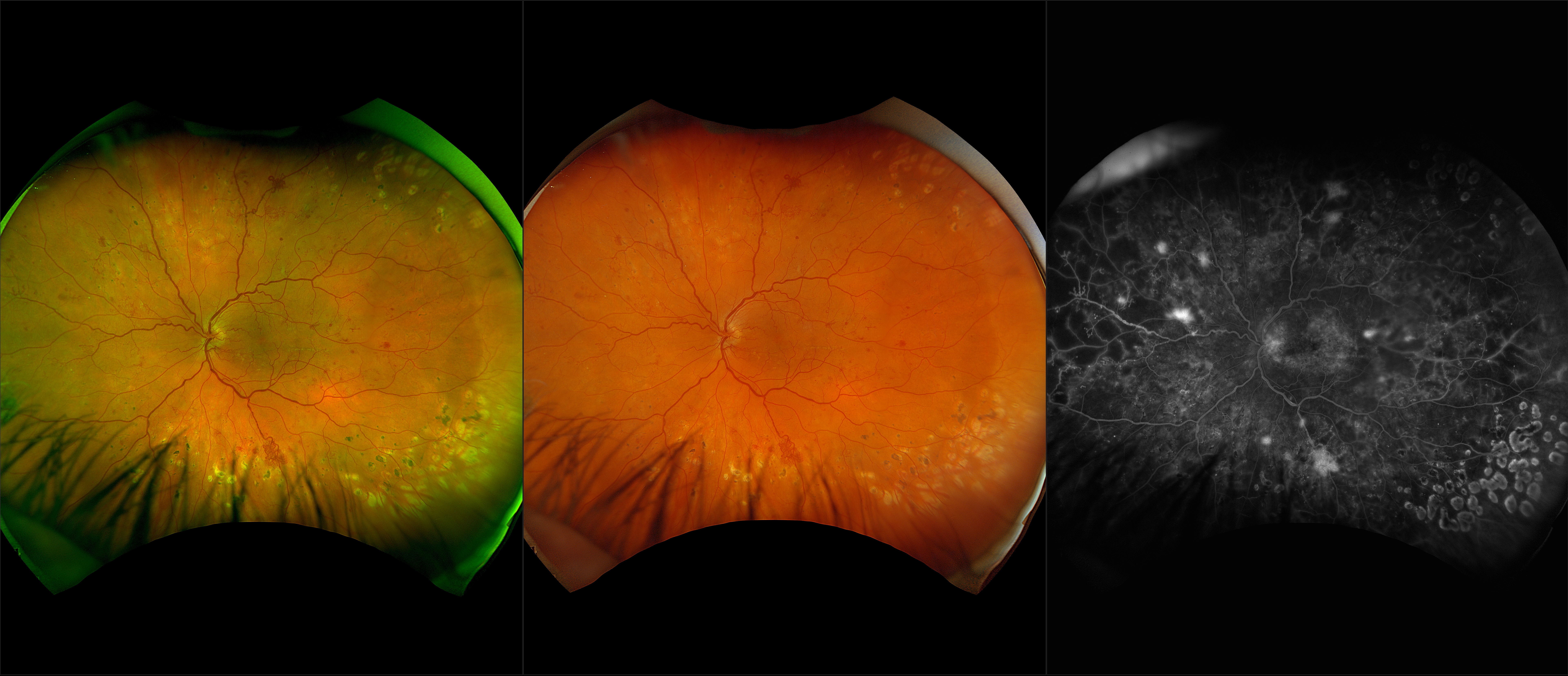 California - Diabetic Retinopathy, RG, RGB, FA